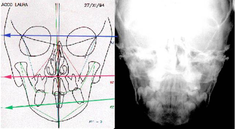 Cefalometria postero anteriore con evidente cross a sx