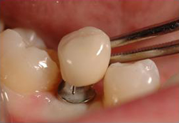 corona in ceramica