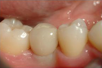 corona in ceramica