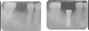 radiografia endorale