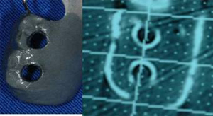 dima chirurgica - dima radiografica