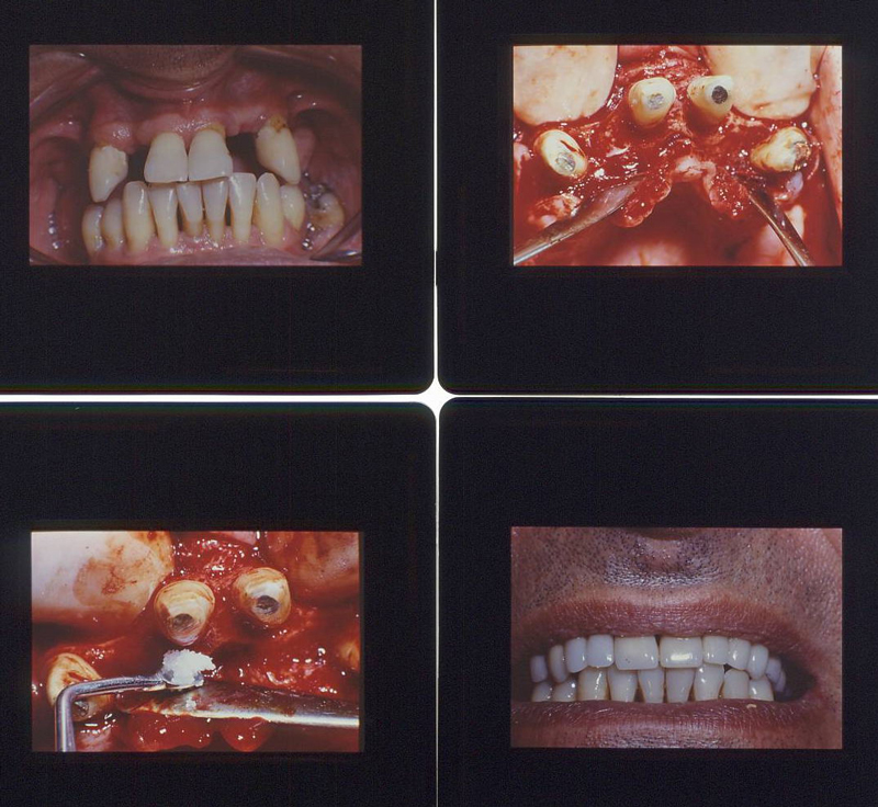 PARODONTITE : Caso clinico prima, durante e dopo la terapia chirurgica parodontale del Dr. Gustavo Petti