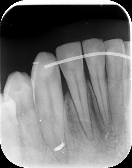 E' possibile che si stia sviluppando un'infezione che non viene riscontrata tramite le lastre e i test di vitalitÃ ?