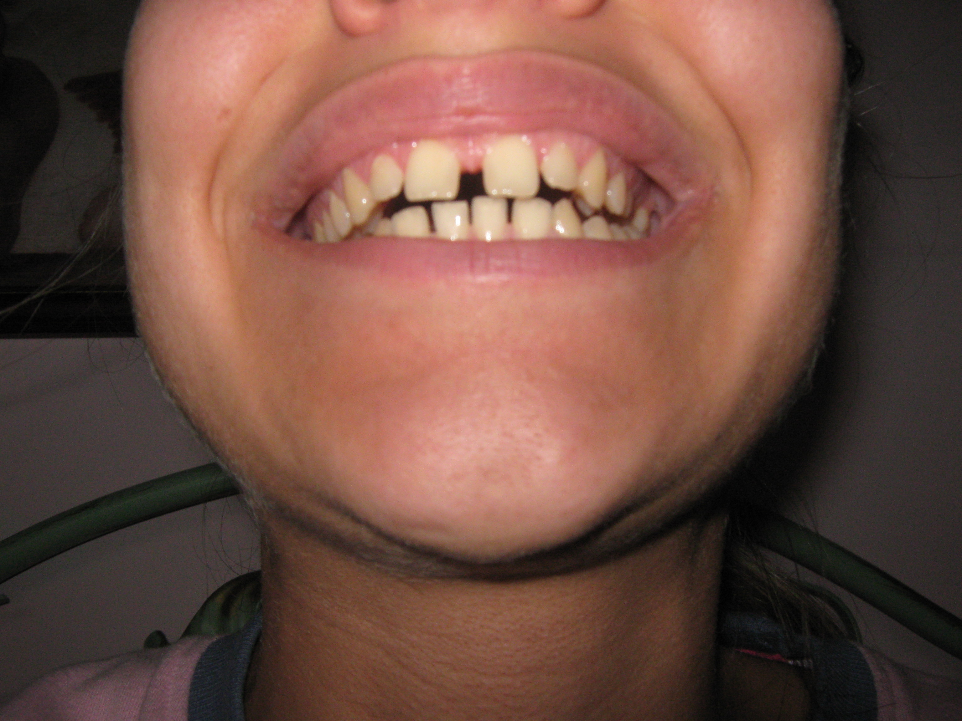 Correzione diastema incisivi superiori