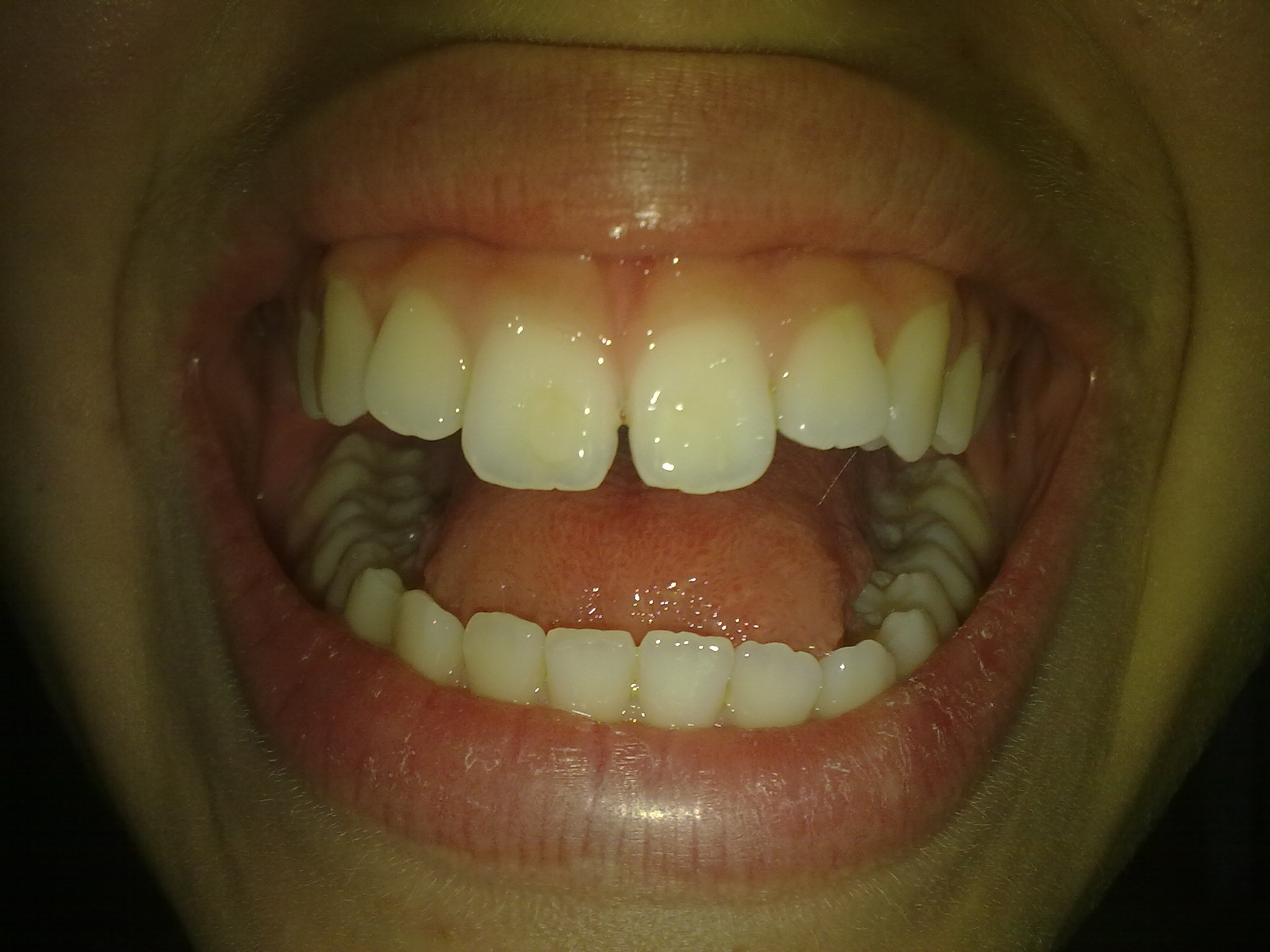 Da circa quattro mesi ho messo l'apparecchio fisso all'arcata superiore dei denti per un problema estetico.