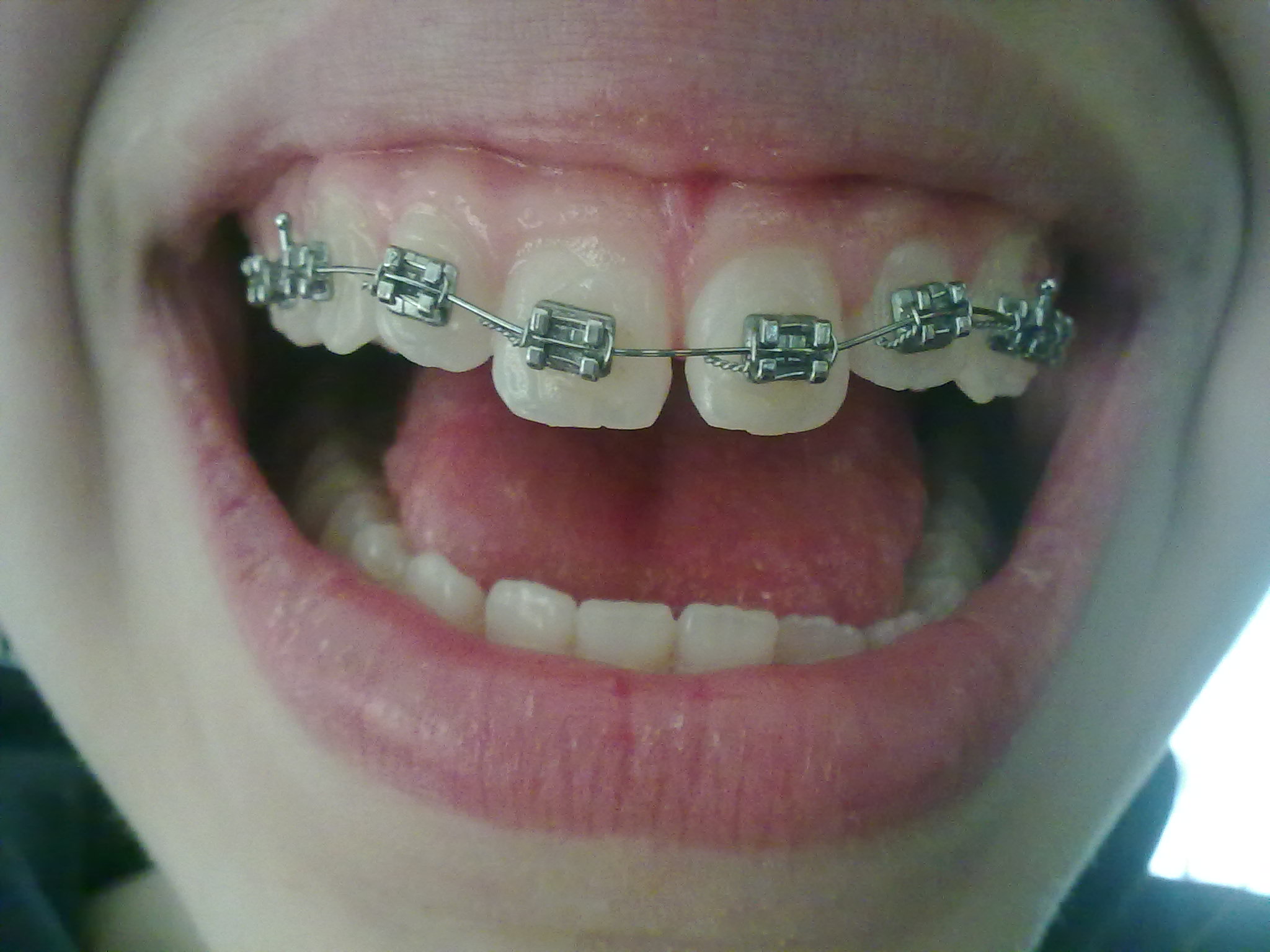 Da circa quattro mesi ho messo l'apparecchio fisso all'arcata superiore dei denti per un problema estetico.