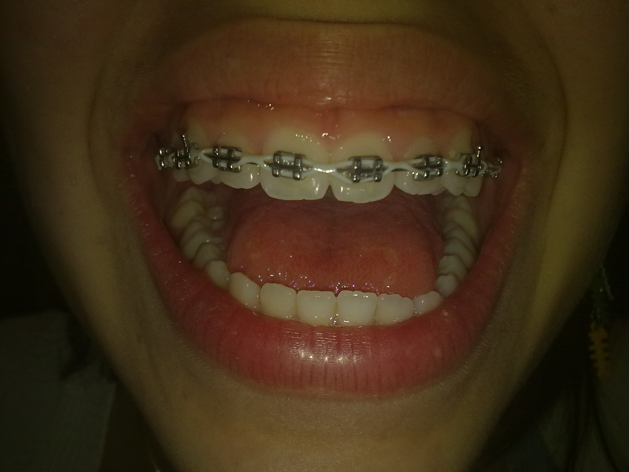Da circa quattro mesi ho messo l'apparecchio fisso all'arcata superiore dei denti per un problema estetico.