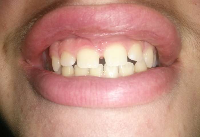 Ho 15 anni e ho un diastema abbastanza evidente