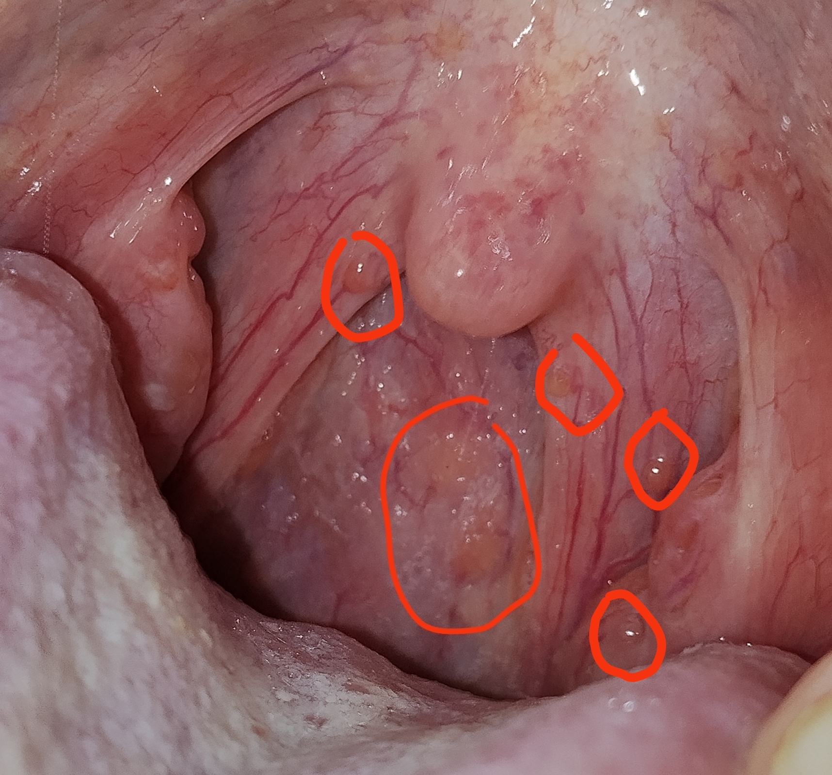 Patina bianca, noduli sulla lingua e mal di gola