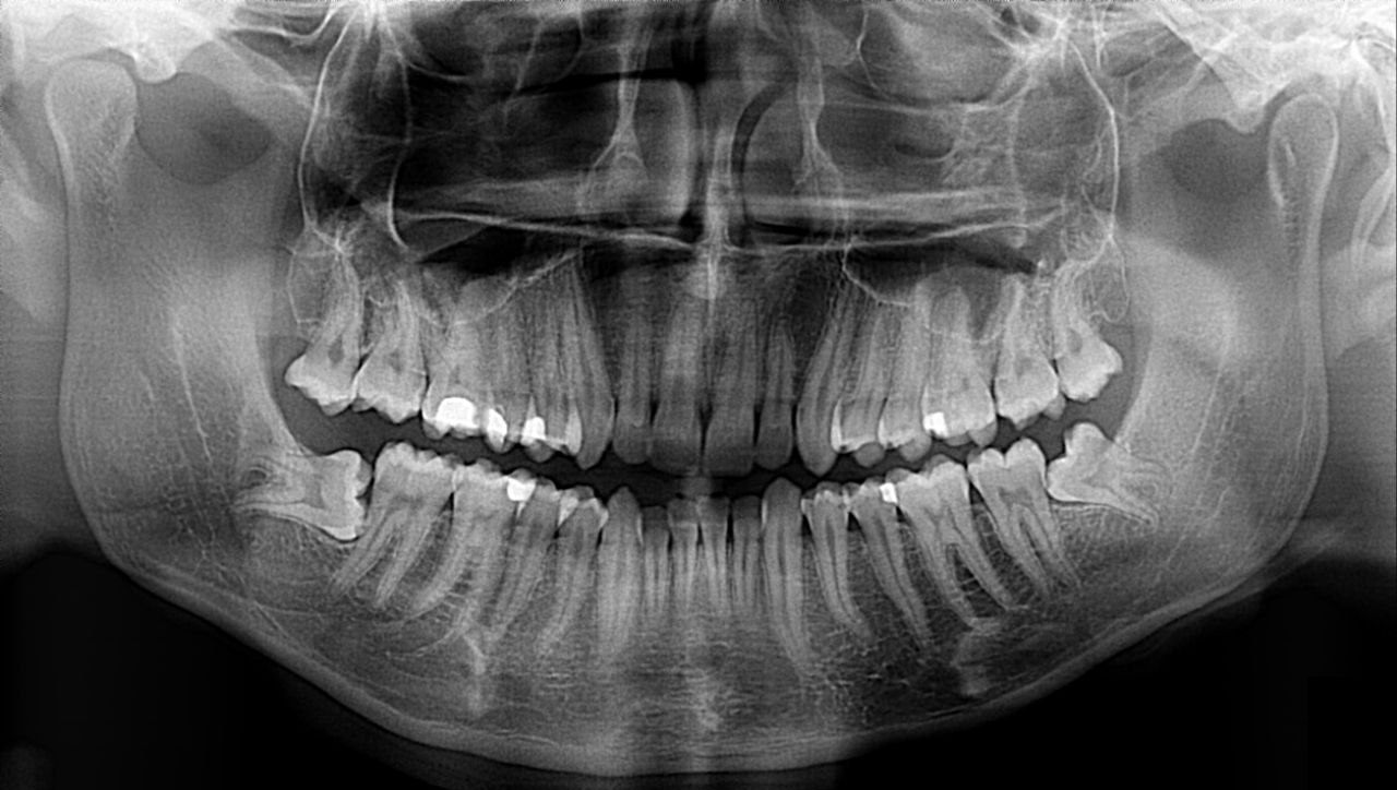 Ã possibile vista la mia situazione evitare l'estrazione denti del giudizio?