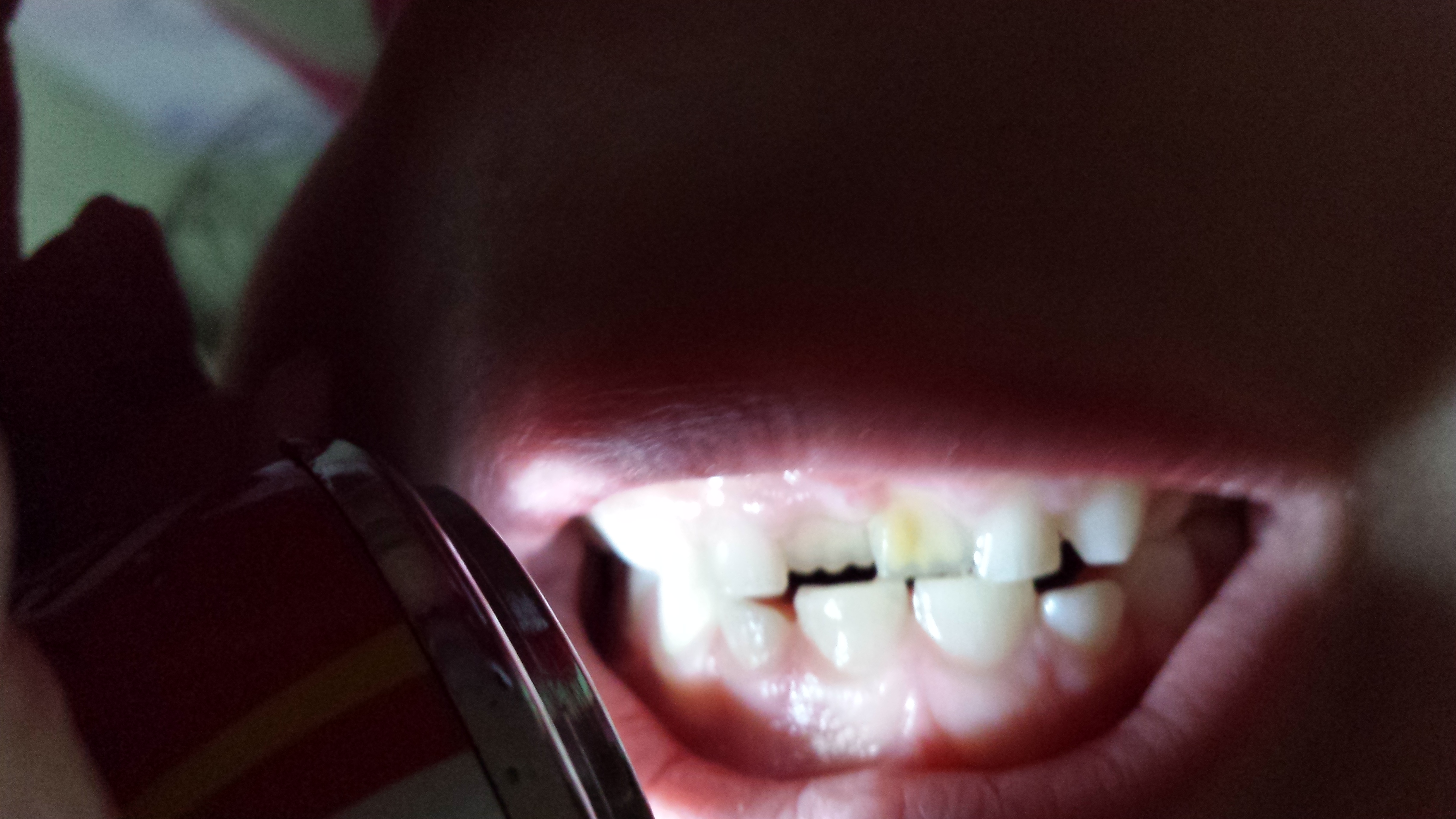 Mia figlia di 5 anni ha una macchia giallastra sul dente