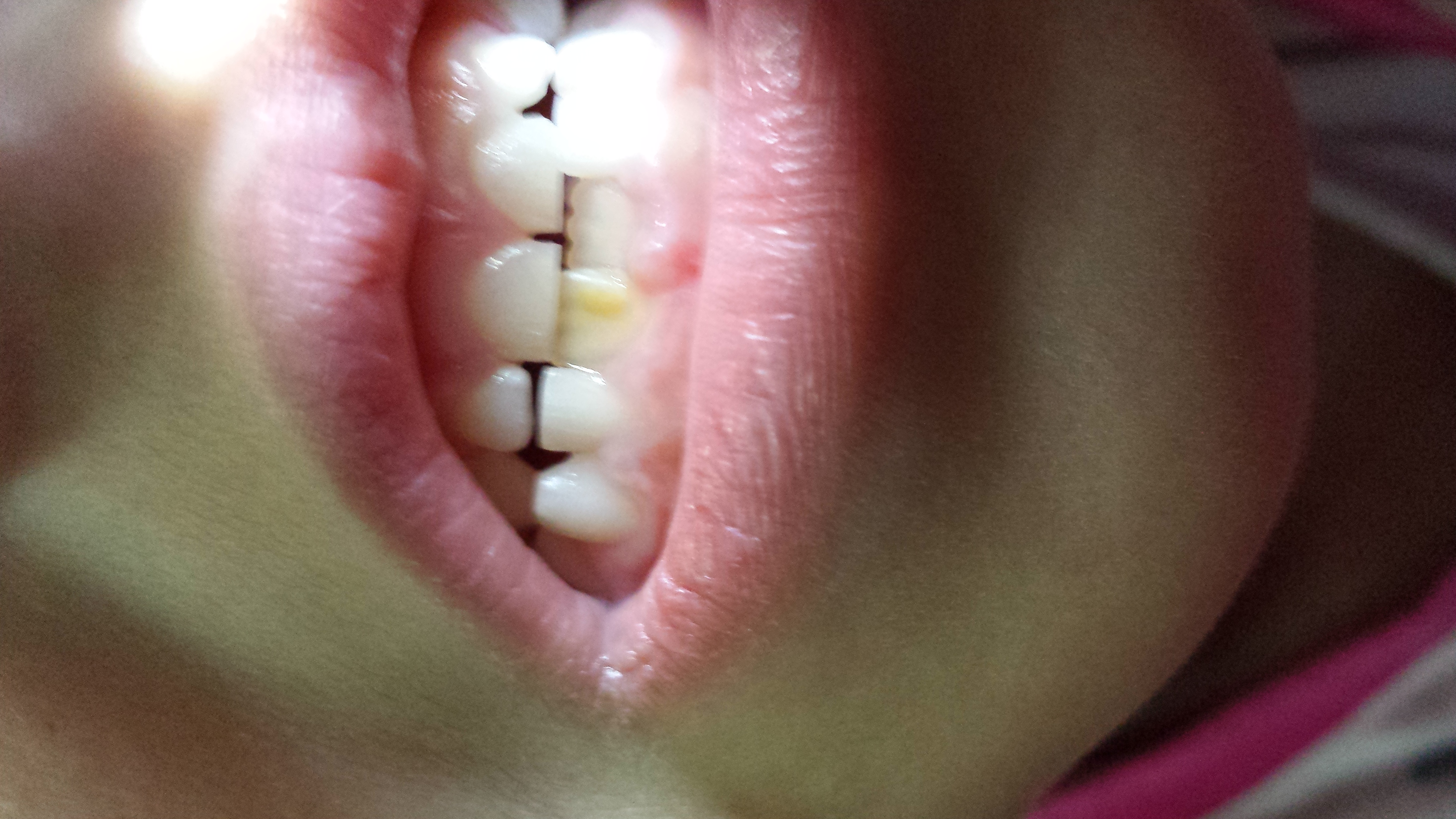 Mia figlia di 5 anni ha una macchia giallastra sul dente