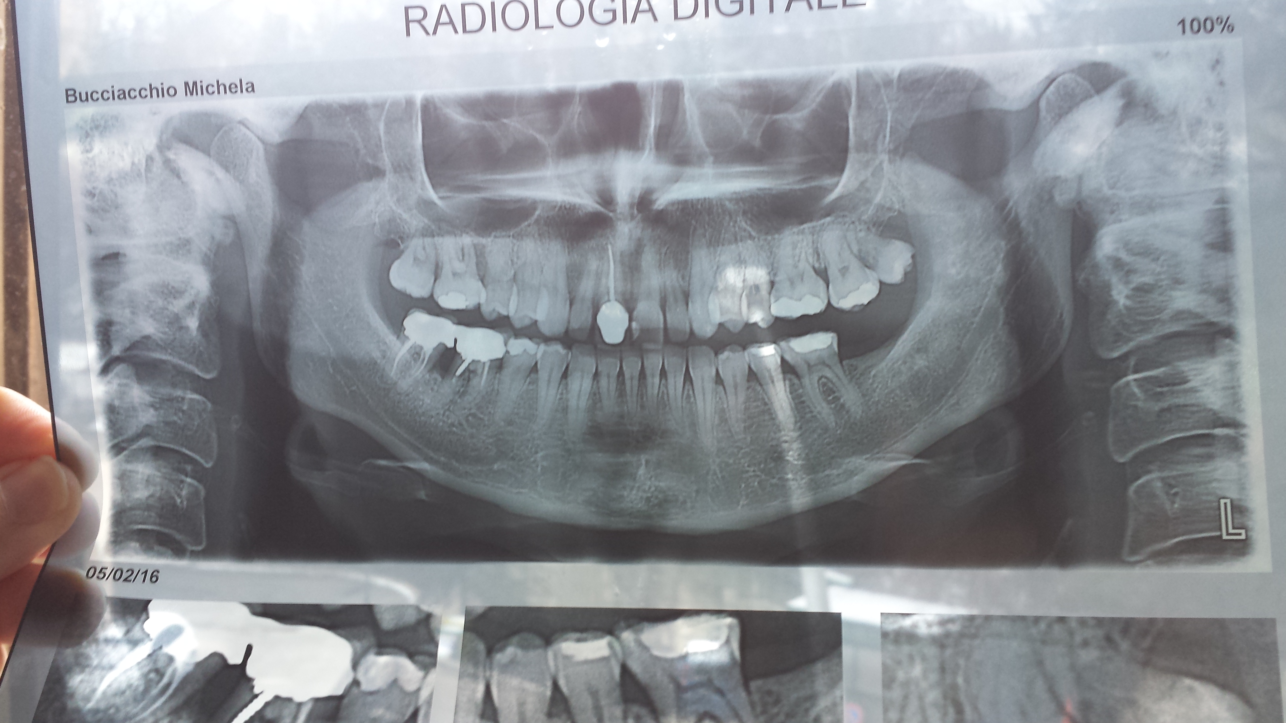 Ho i 2 molari dell'arcata inferiore destra devitalizzati ed incapsulati da una corona unica da 15 anni
