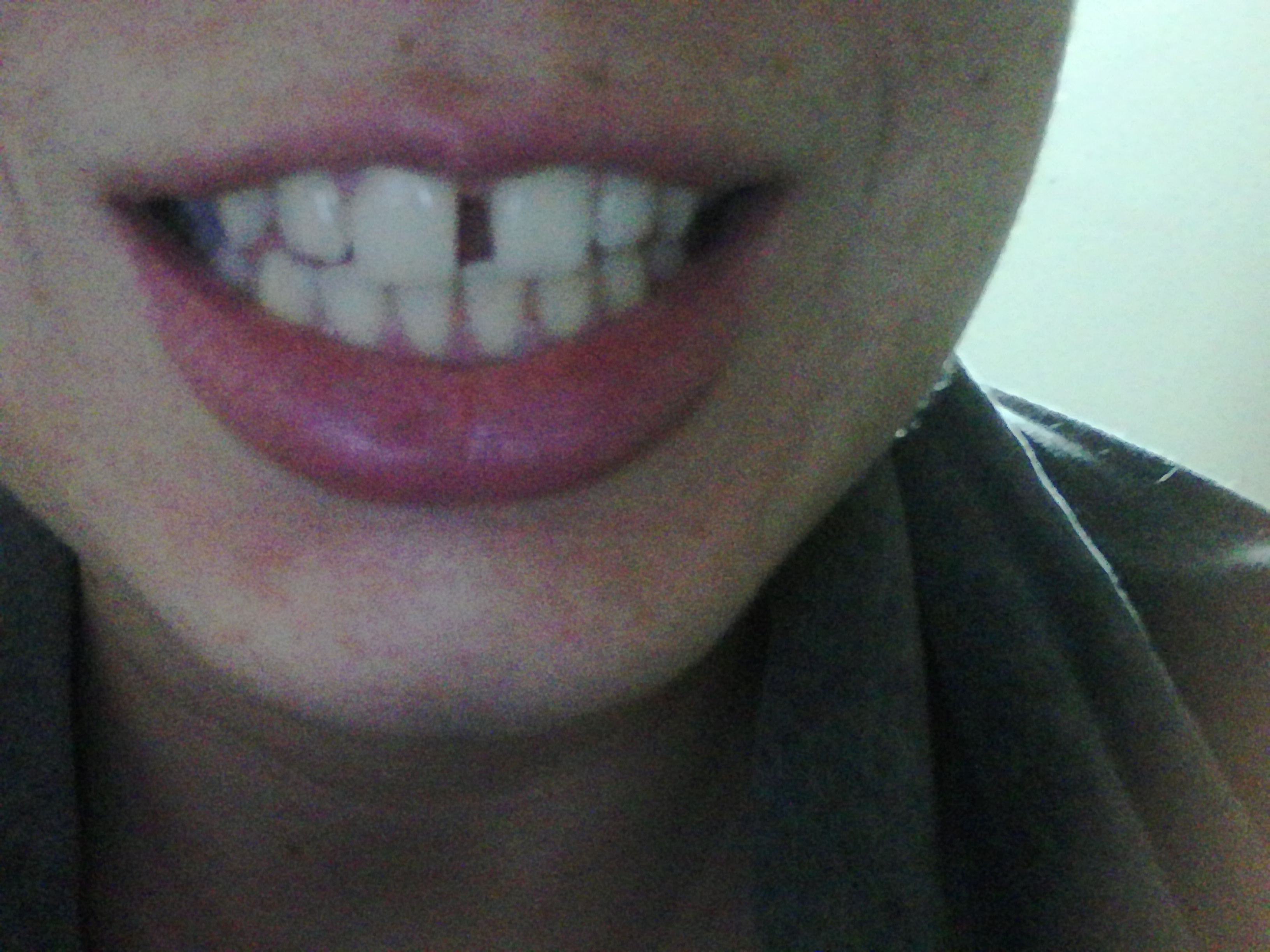 Ho un diastema di circa 2mm