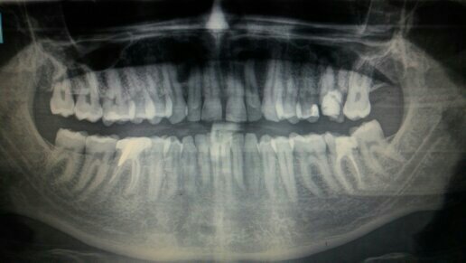 Dente storto dopo trauma dentale