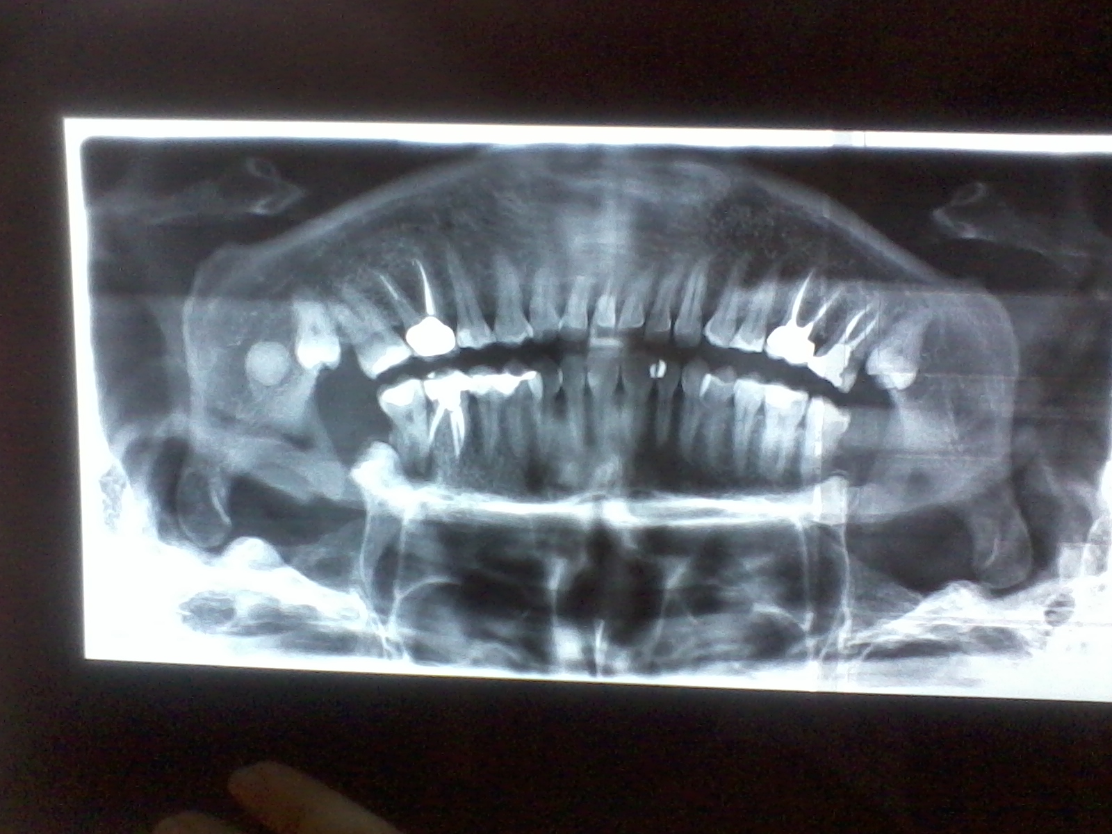 Tra pochi giorni dovrò procedere all'estrazione del settimo dente causa granuloma
