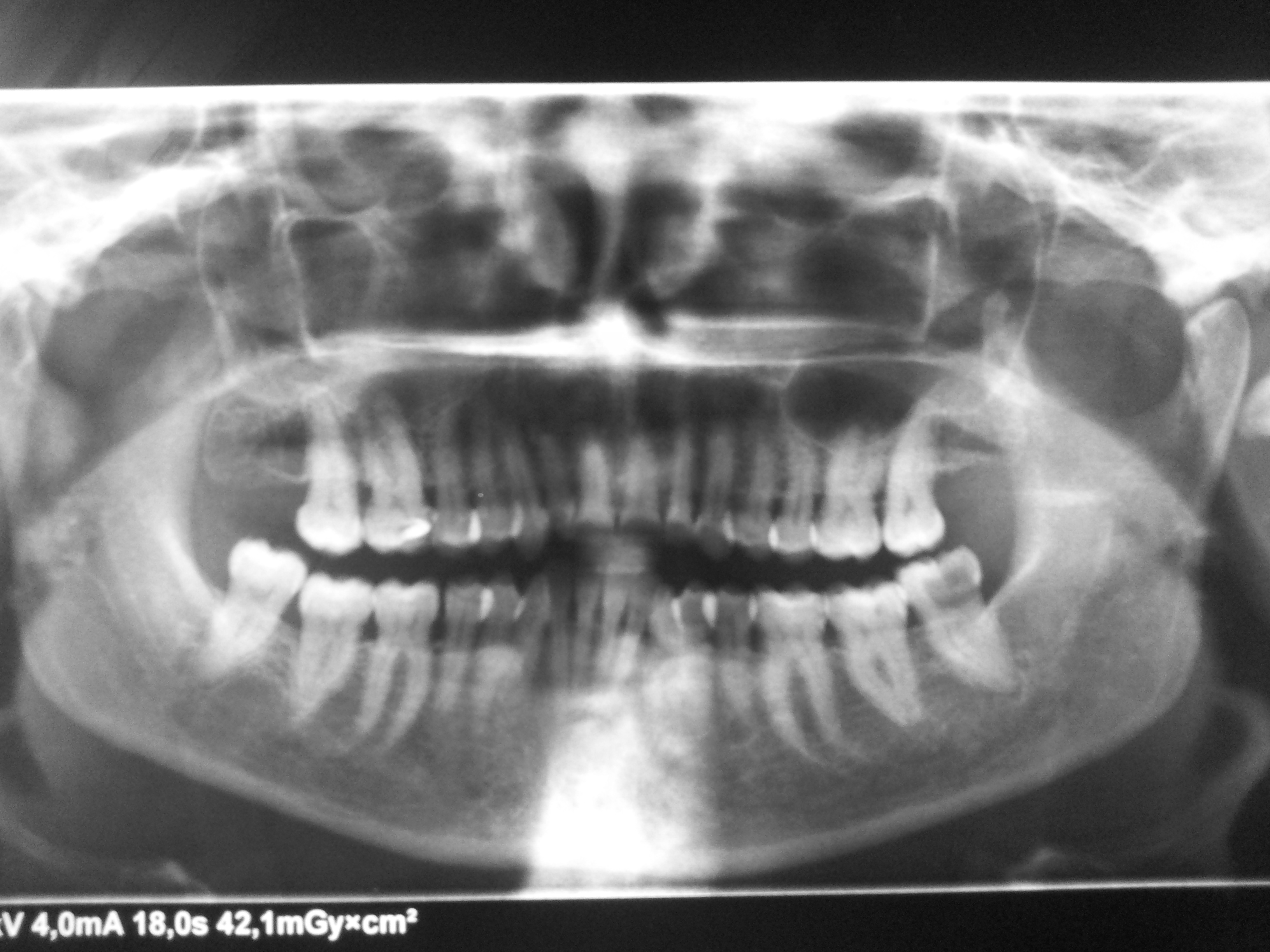 Come sono scomparse le crisi al trigemino è scomparso anche il mal di denti