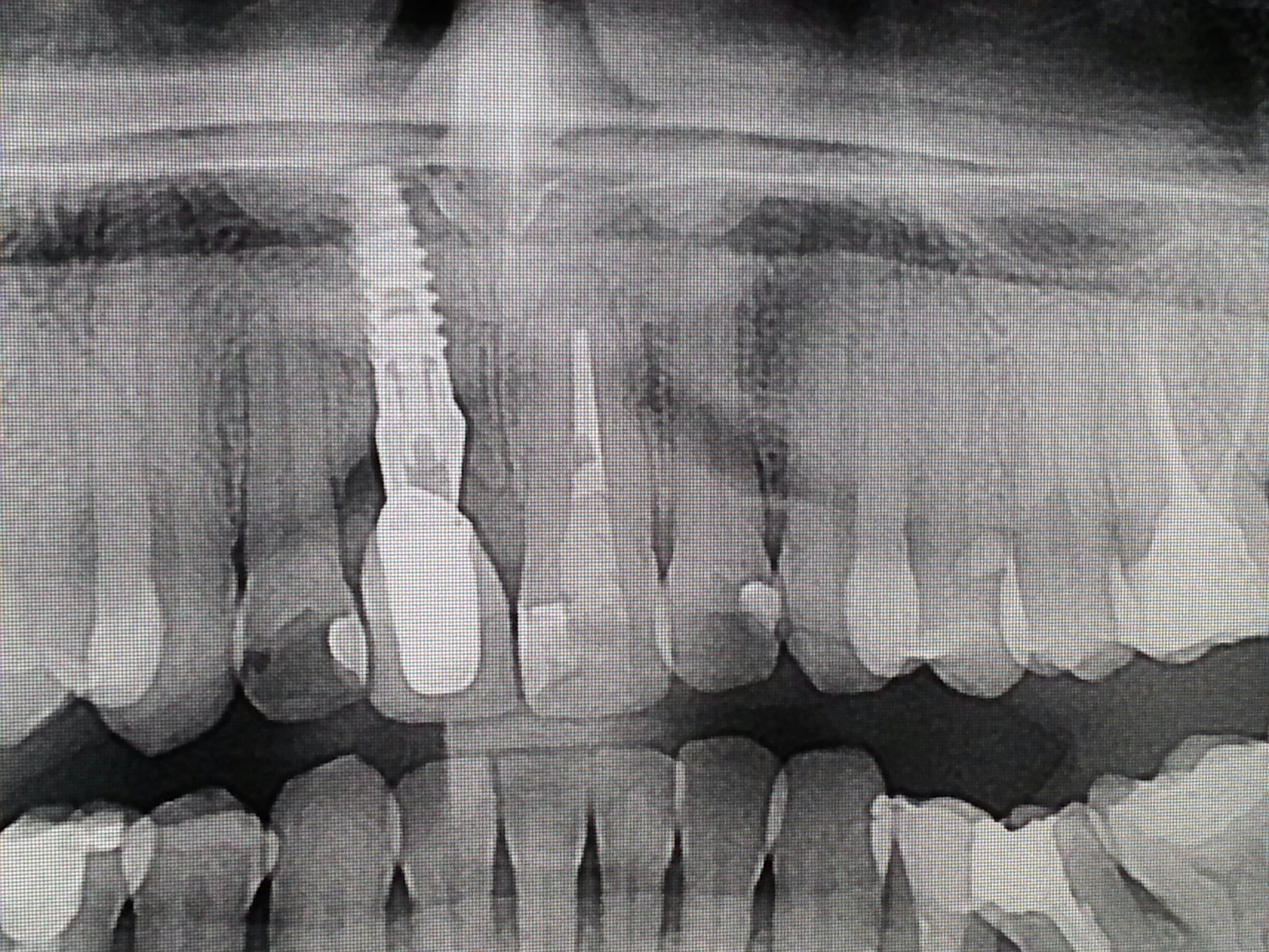 Ho una sorta di dolore fastidio al dente incisivo superiore