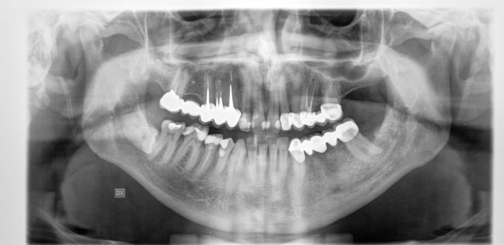 Questo dolore puÃ² essere imputabile al dente del giudizio ancora incluso?