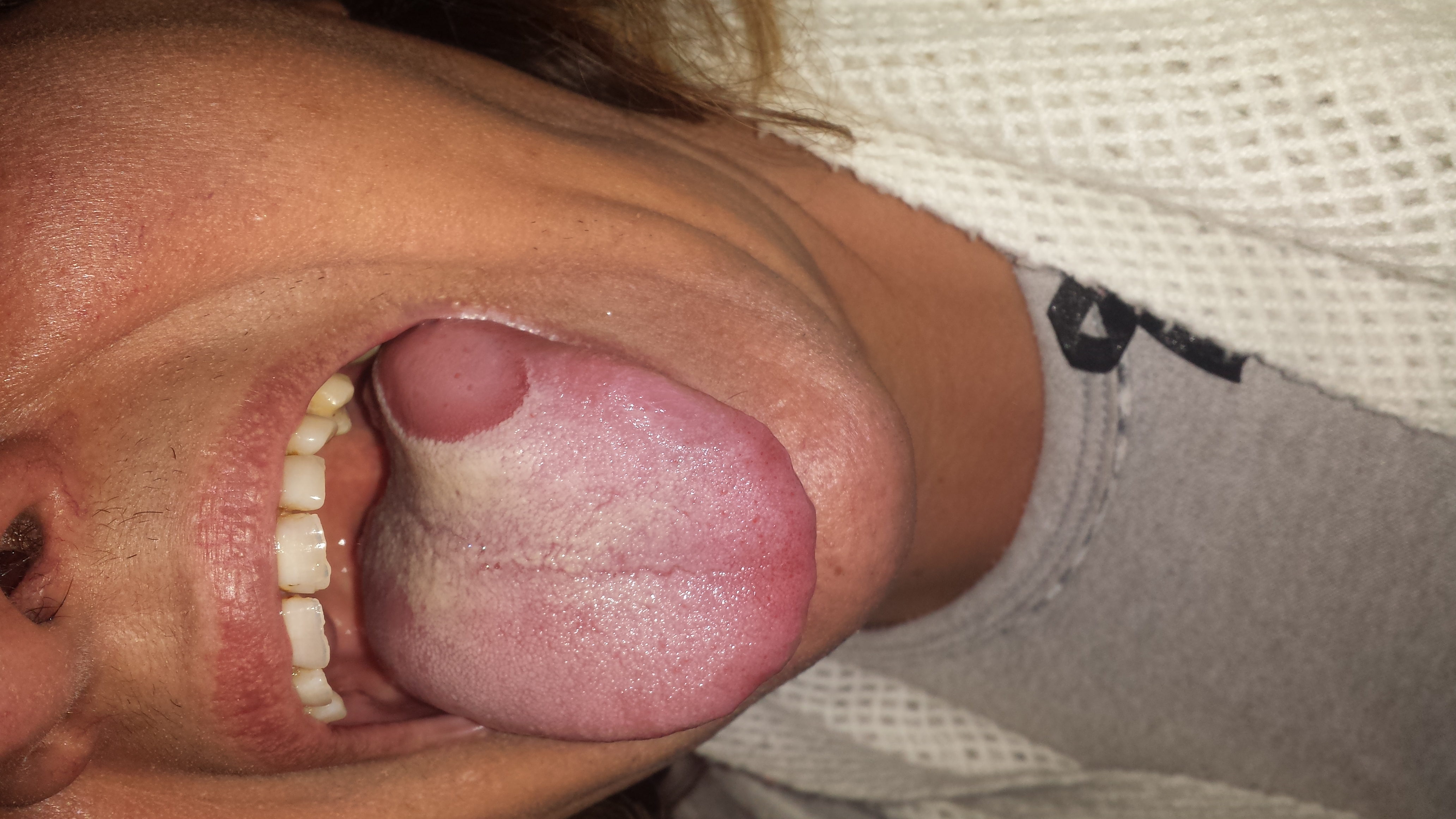 A mia mamma è uscita un'ulcera alla lingua