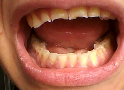 A causa del mio bruxismo devo incapsulare tutti i denti?