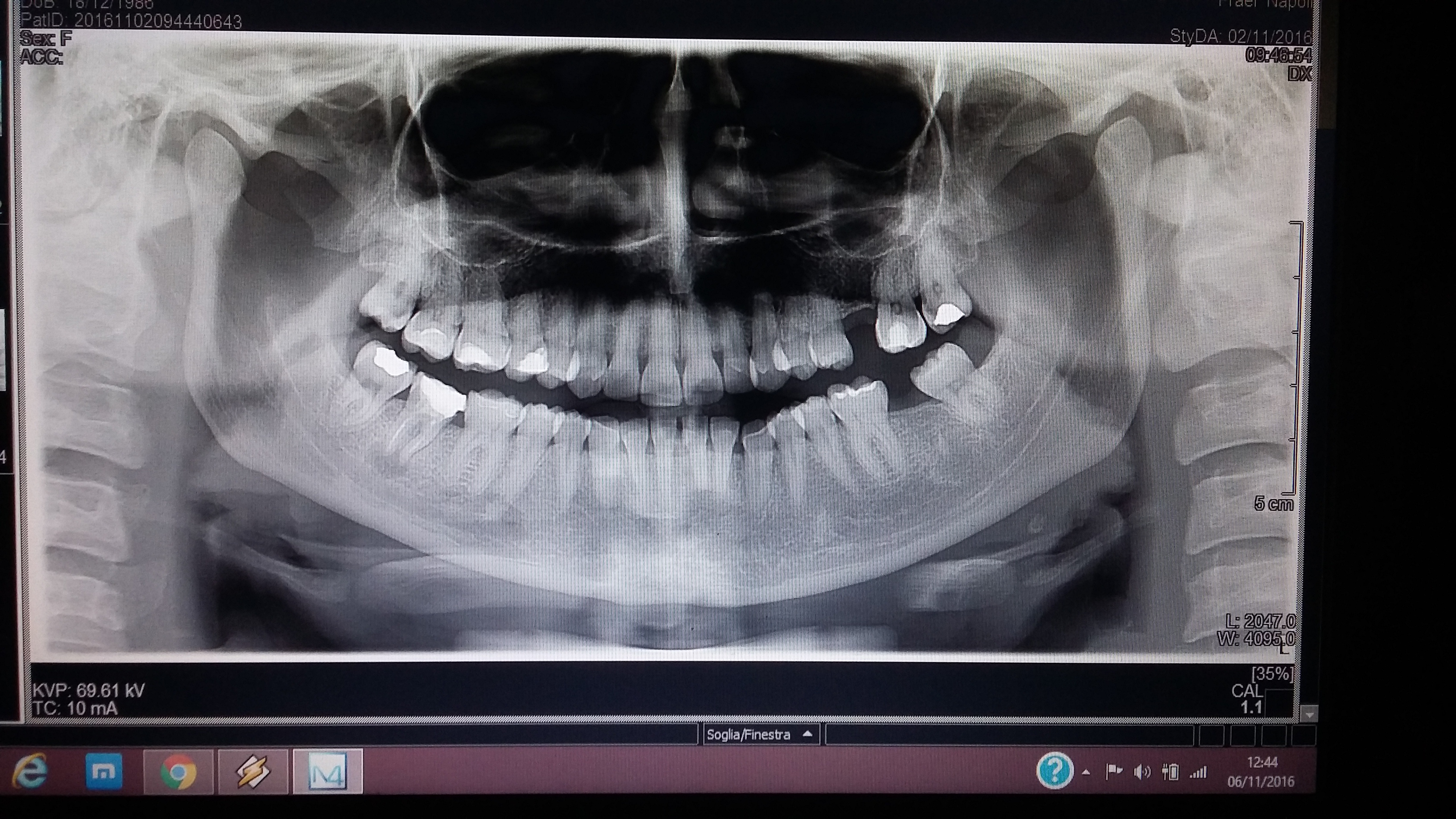 Secondo voi il dente 47 va estratto?