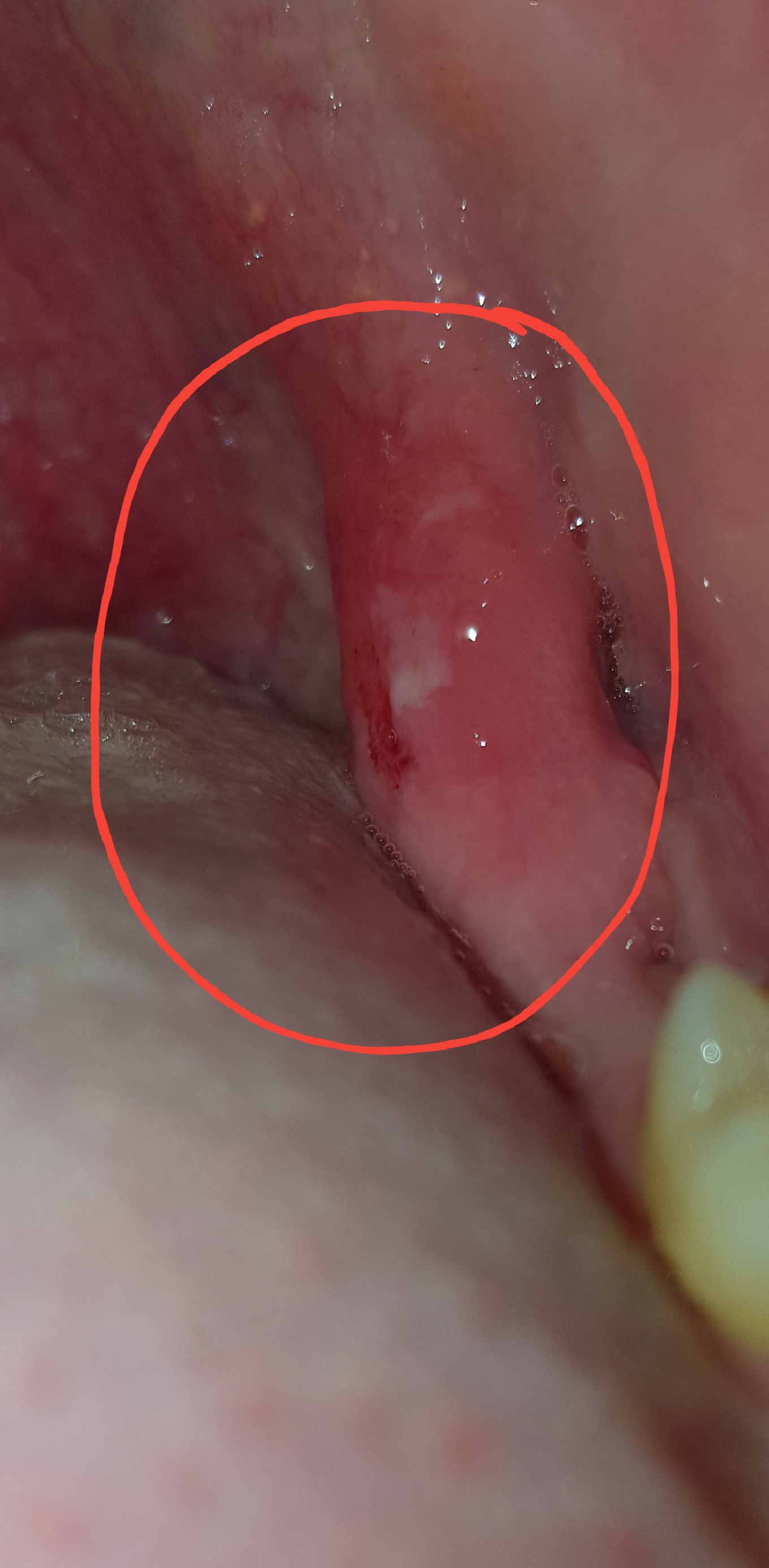 Potrebbe essere una scheggia rimasta dentro?