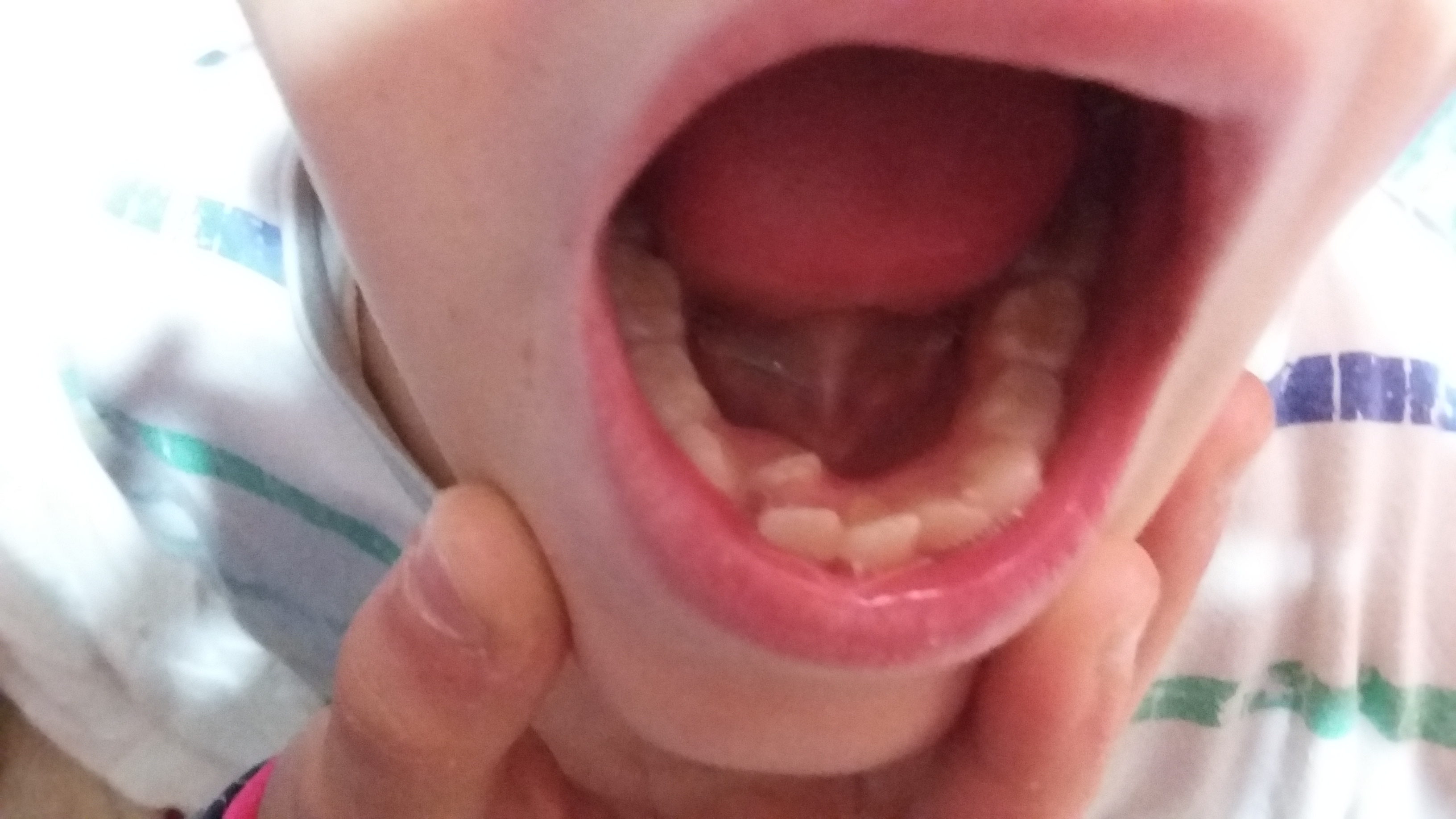 Affollamento di denti nell'arcata inferiore