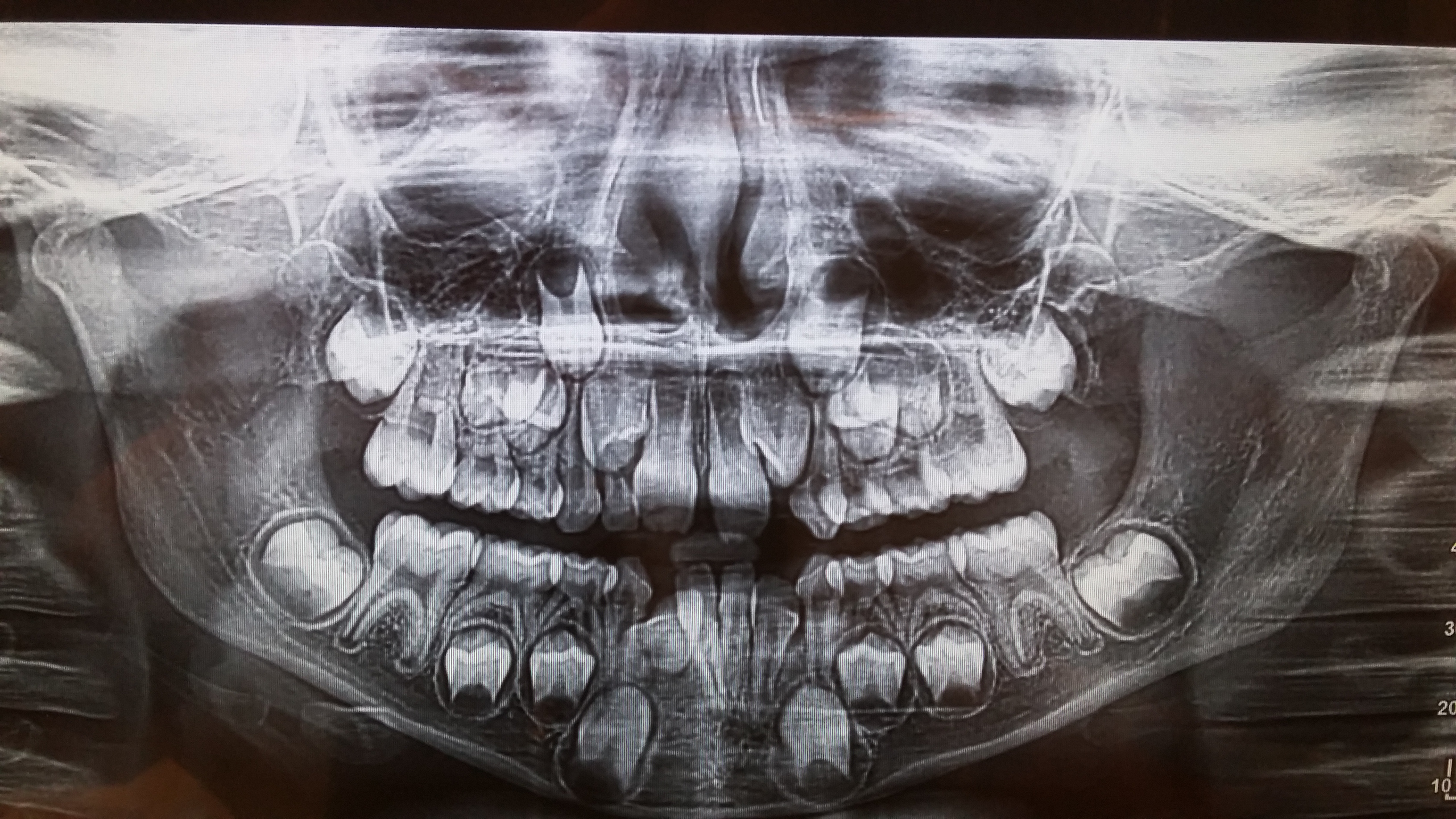 Affollamento di denti nell'arcata inferiore