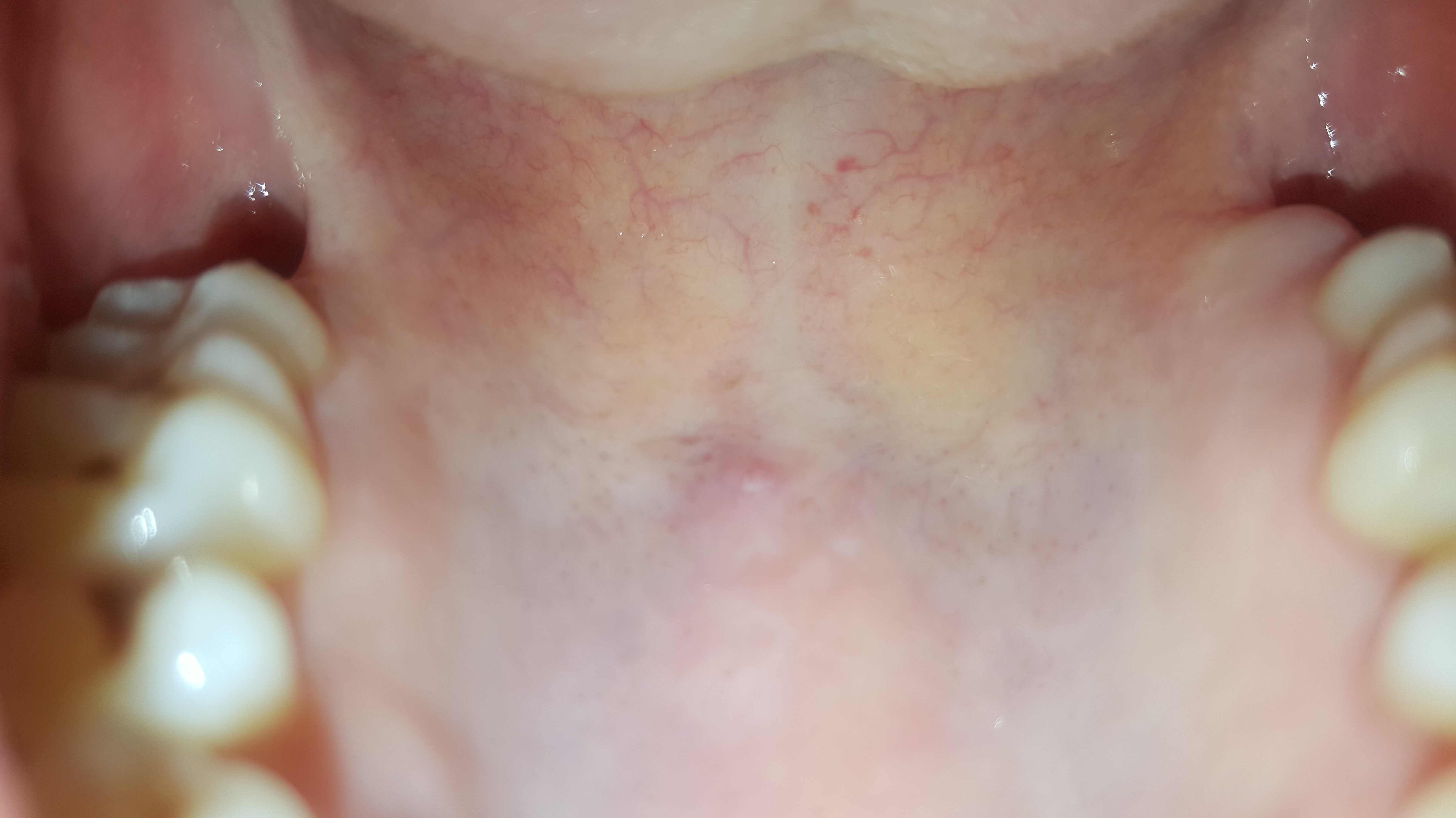 Papilloma virus palato, Throat cancer from hpv symptoms