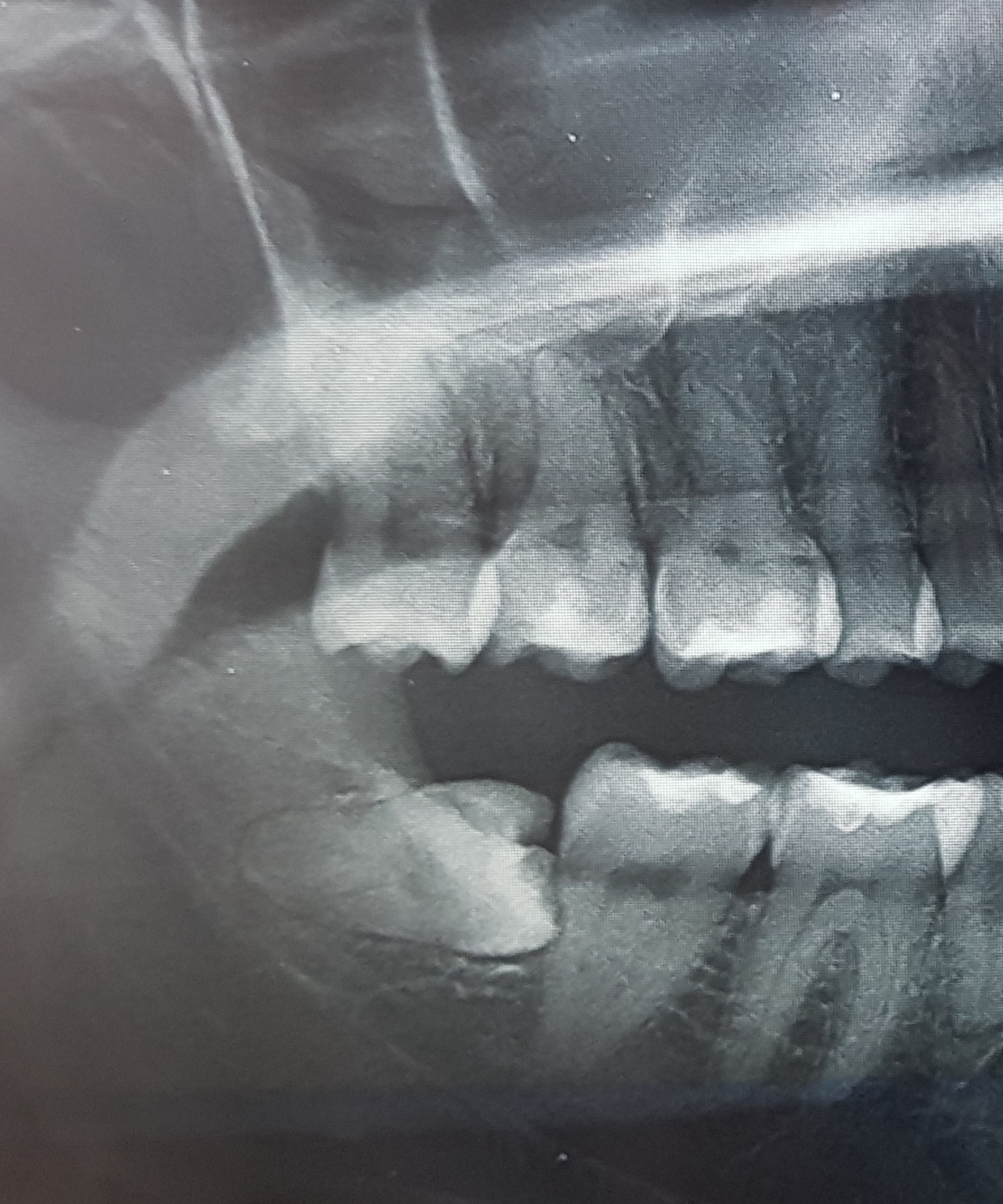 Il dente è da estrarre il prima possibile oppure si può ancora aspettare?
