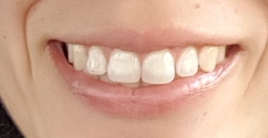 Ho notato che la parte ''finale'' dei denti è trasparente, è normale?