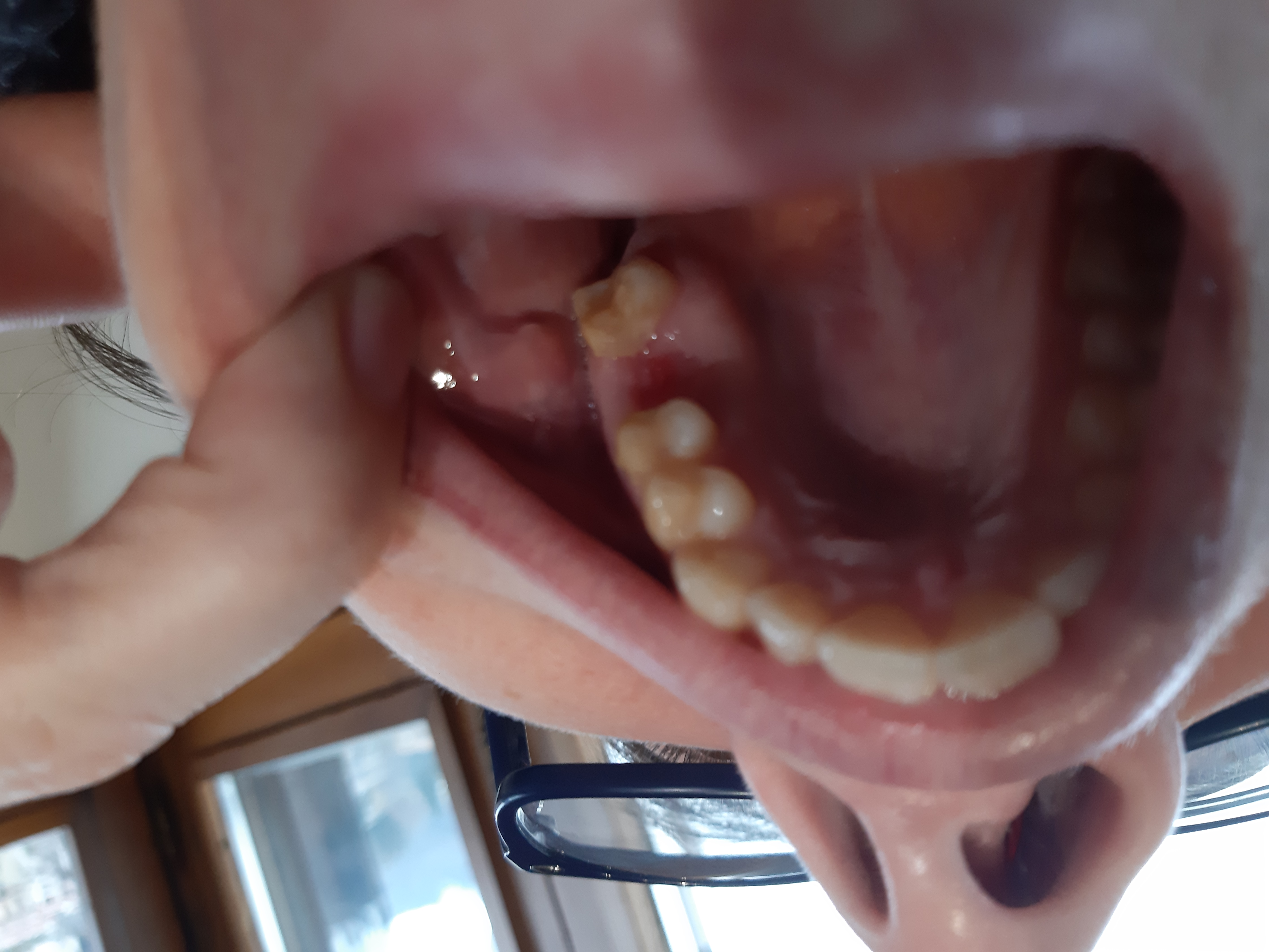 Granuloma su un dente devitalizzato