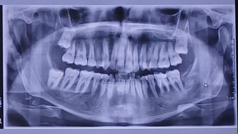 Nel mio caso Ã¨ necessario rimuovere i denti del giudizio?