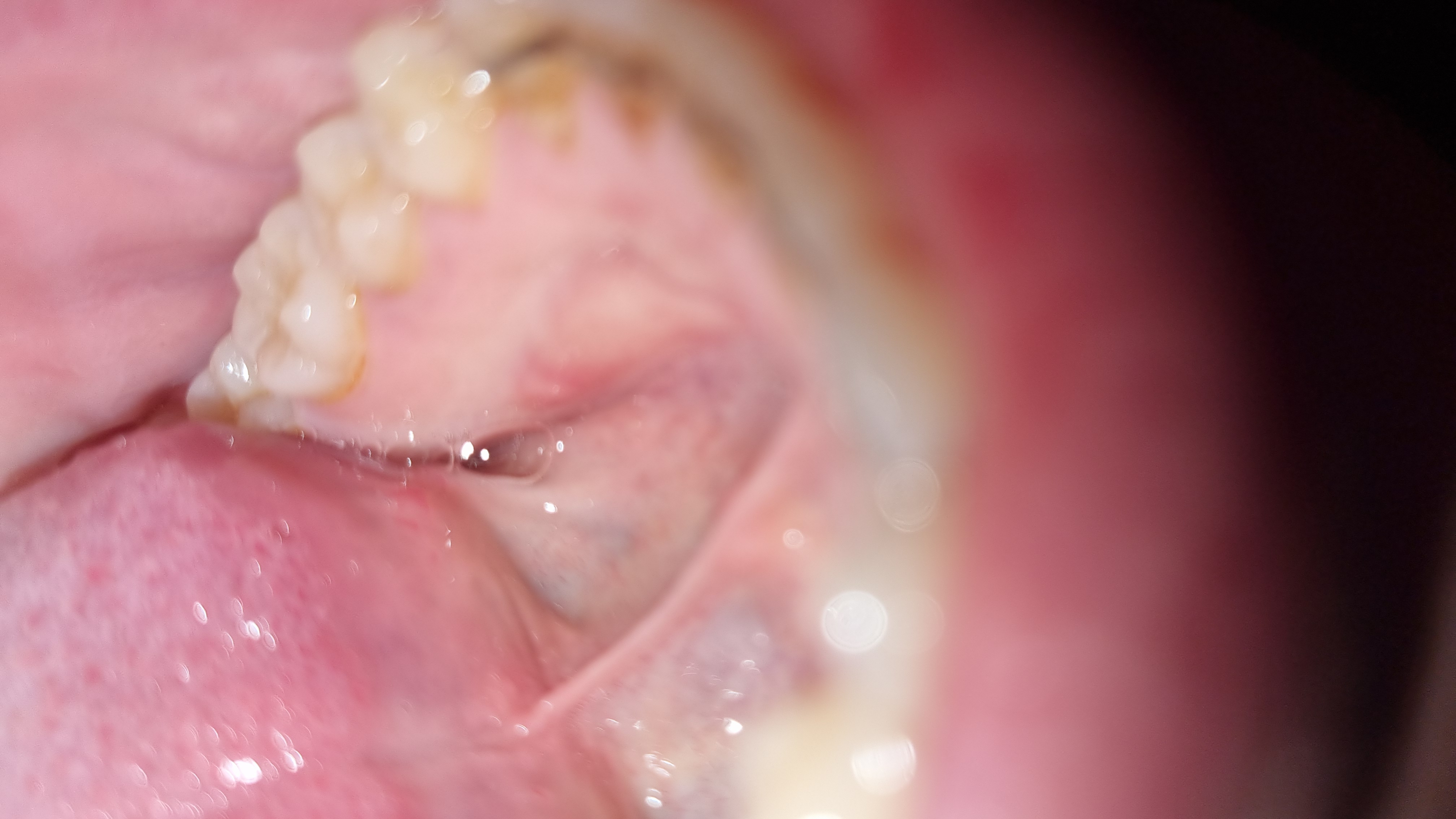 Rigonfiamento nel palato inferiore: cosa potrebbe essere?