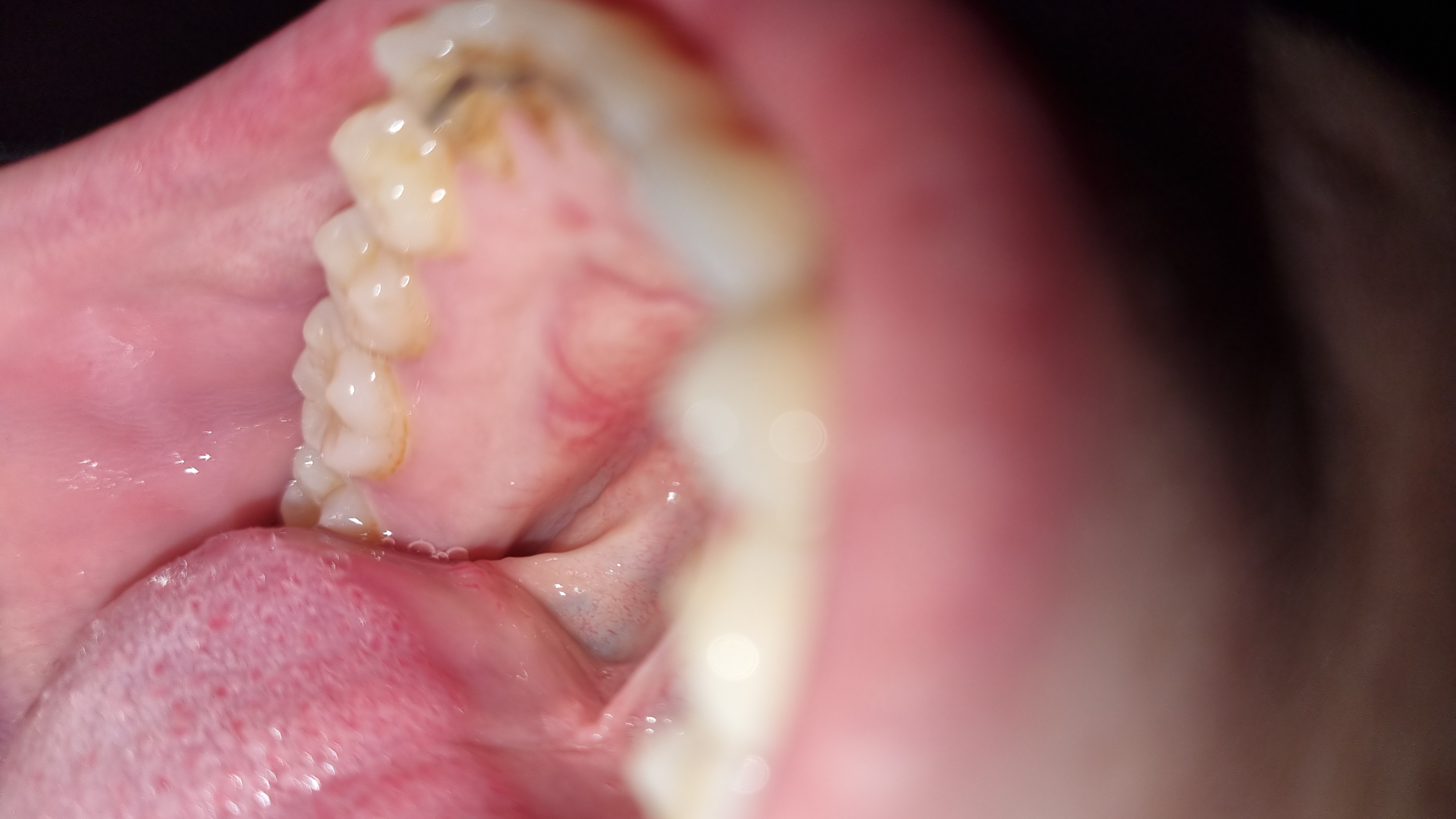 Rigonfiamento nel palato inferiore: cosa potrebbe essere?
