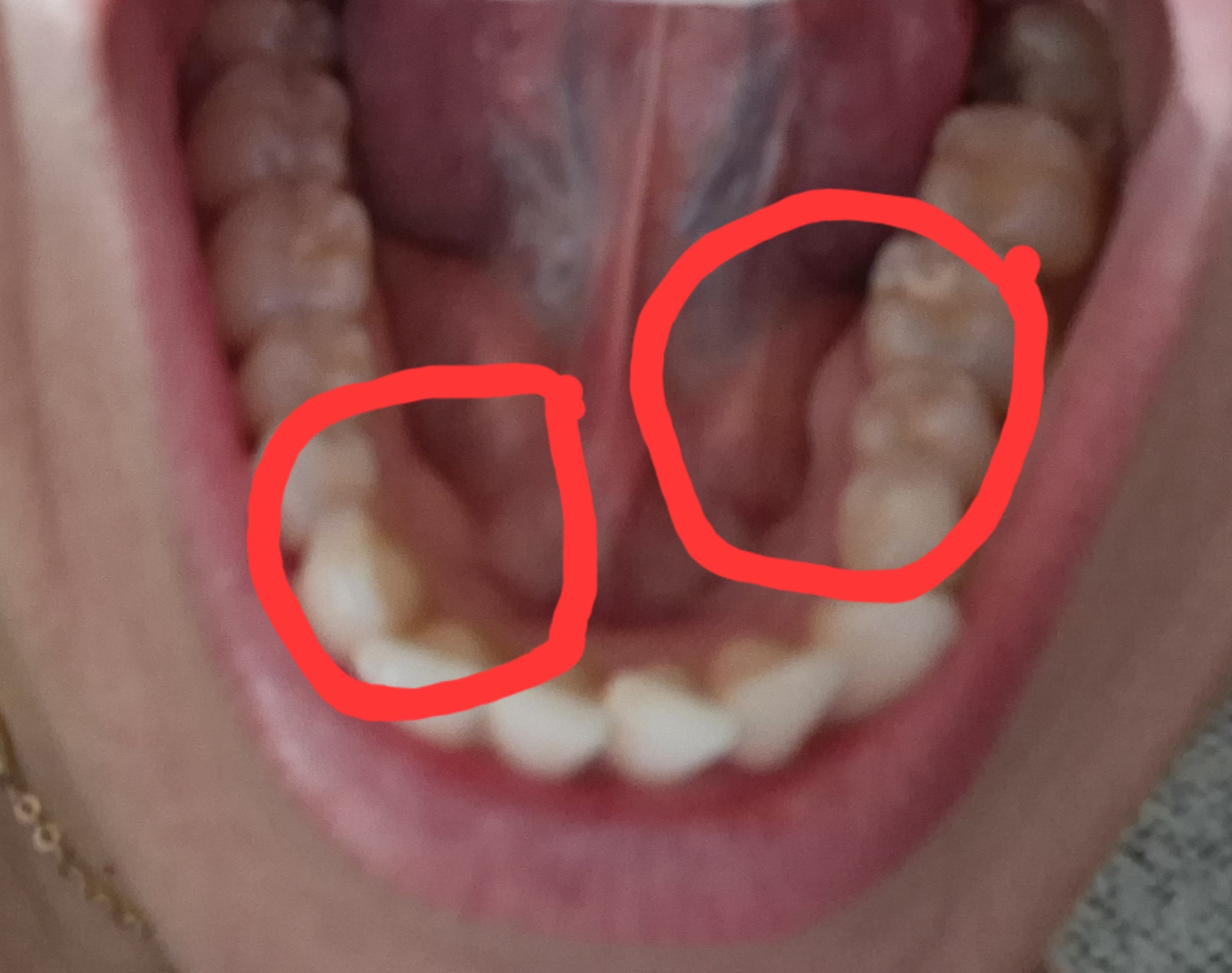 Rigonfiamenti ossei sulle gengive: cosa potrebbero essere?