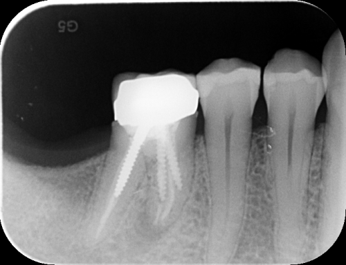 Ã possibile salvare il dente?