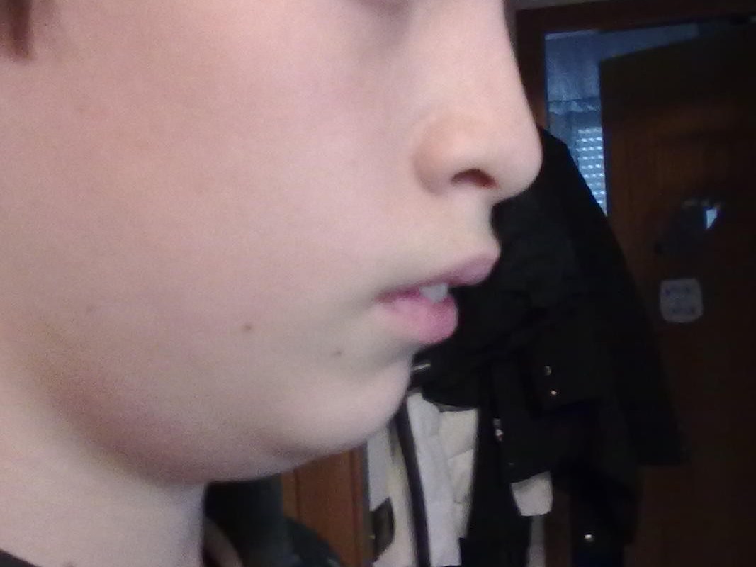A mio figlio di 13 anni è stato diagnosticato un problema di malocclusione