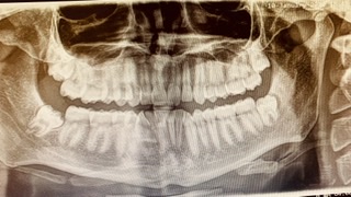 Secondo voi puÃ² essere causato tutto ciÃ² dai denti del giudizio?