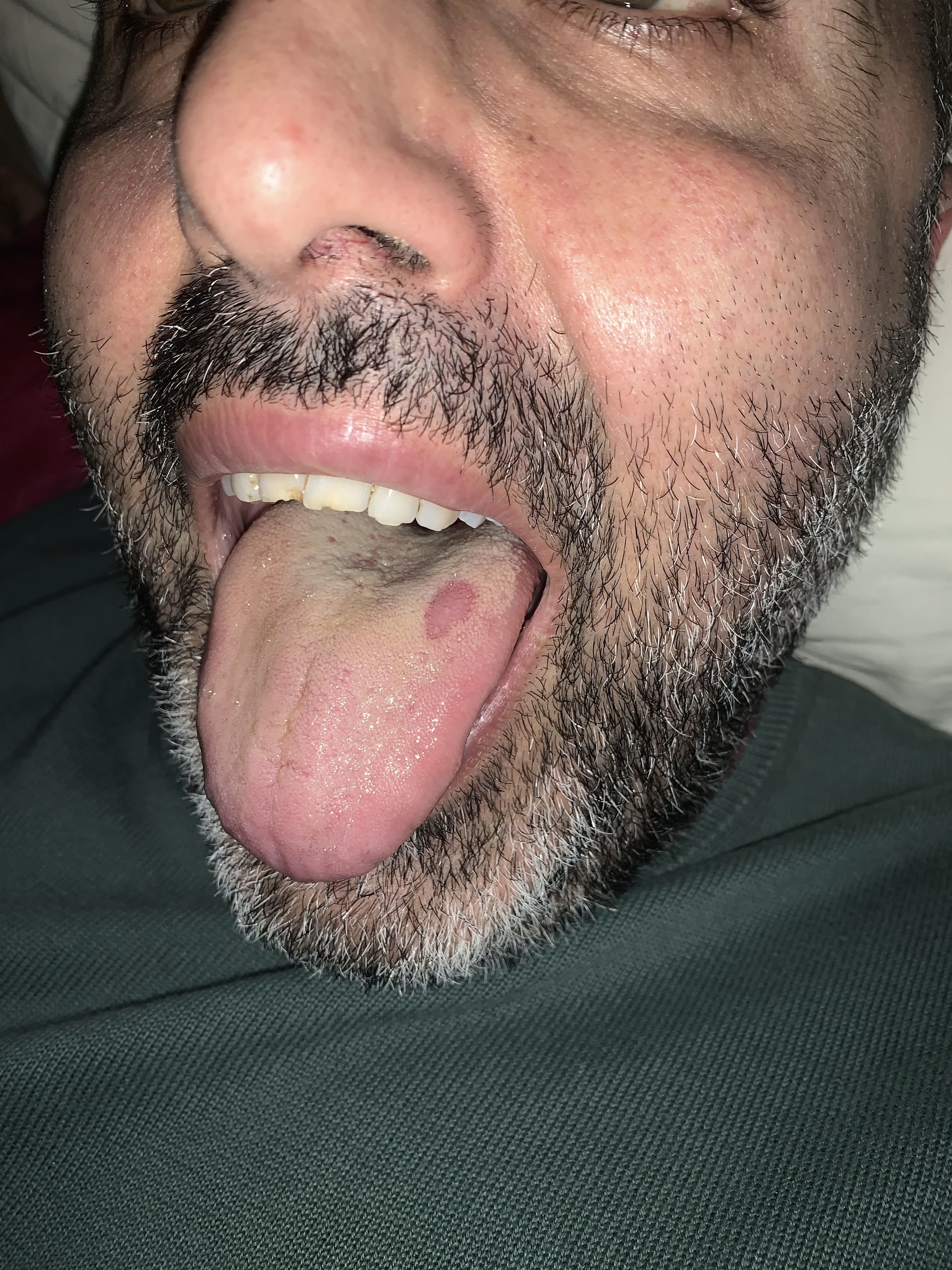 Da stamattina mi ritrovo una macchia rossa sulla lingua
