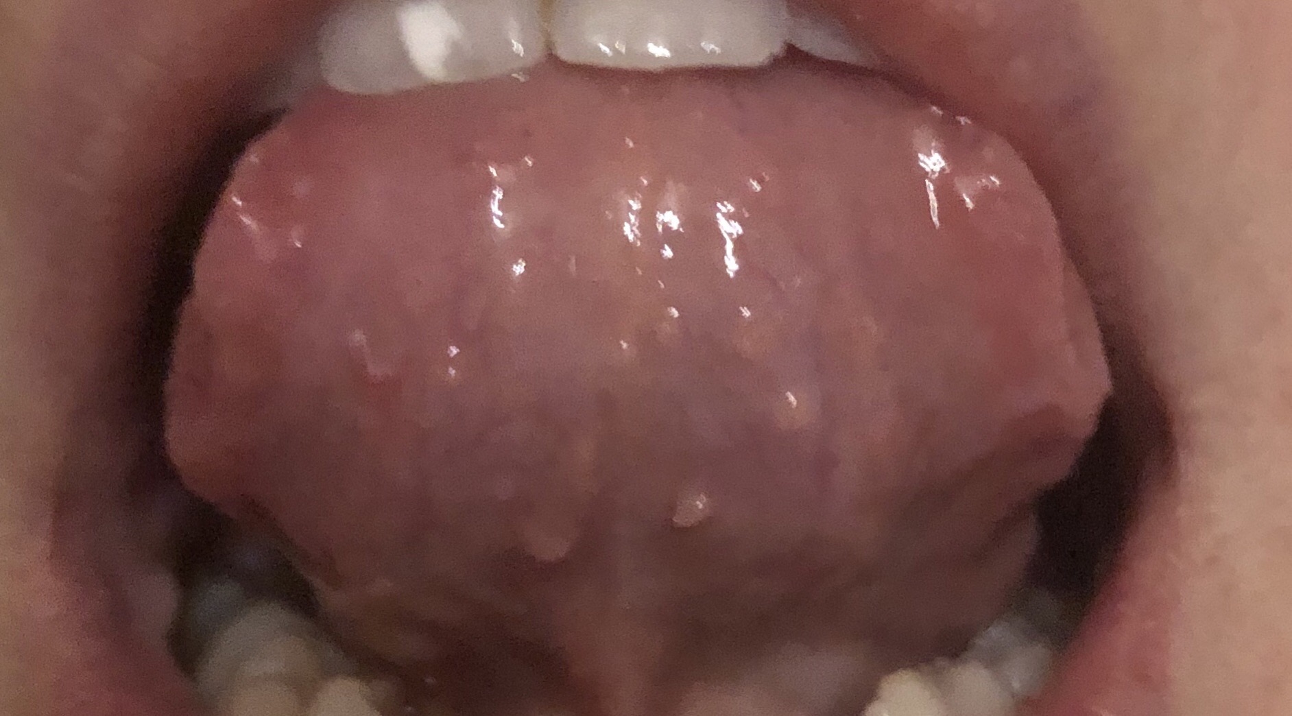 papilloma sotto la lingua