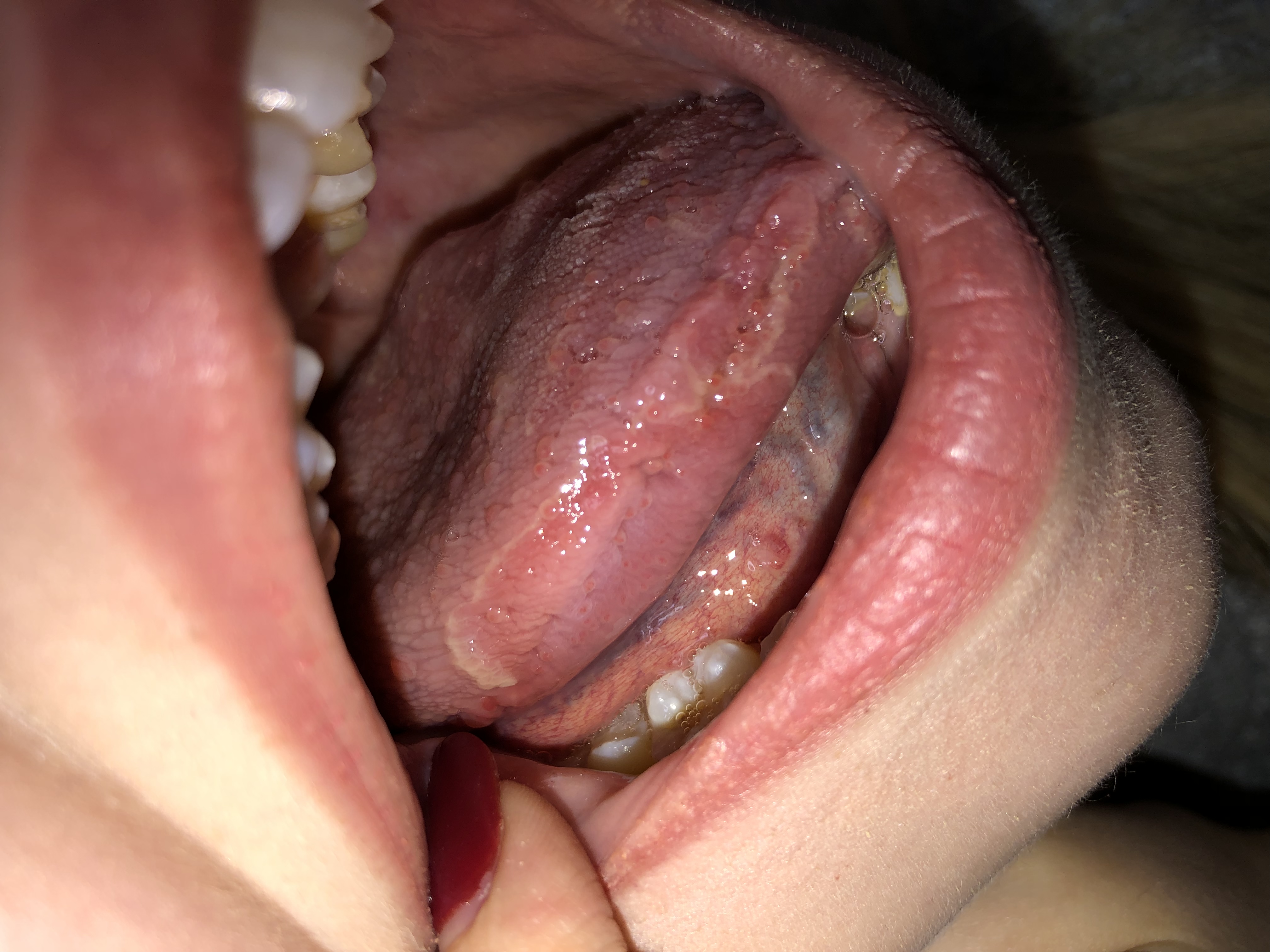 Lingua con puntini bianchi e rossi da due settimane