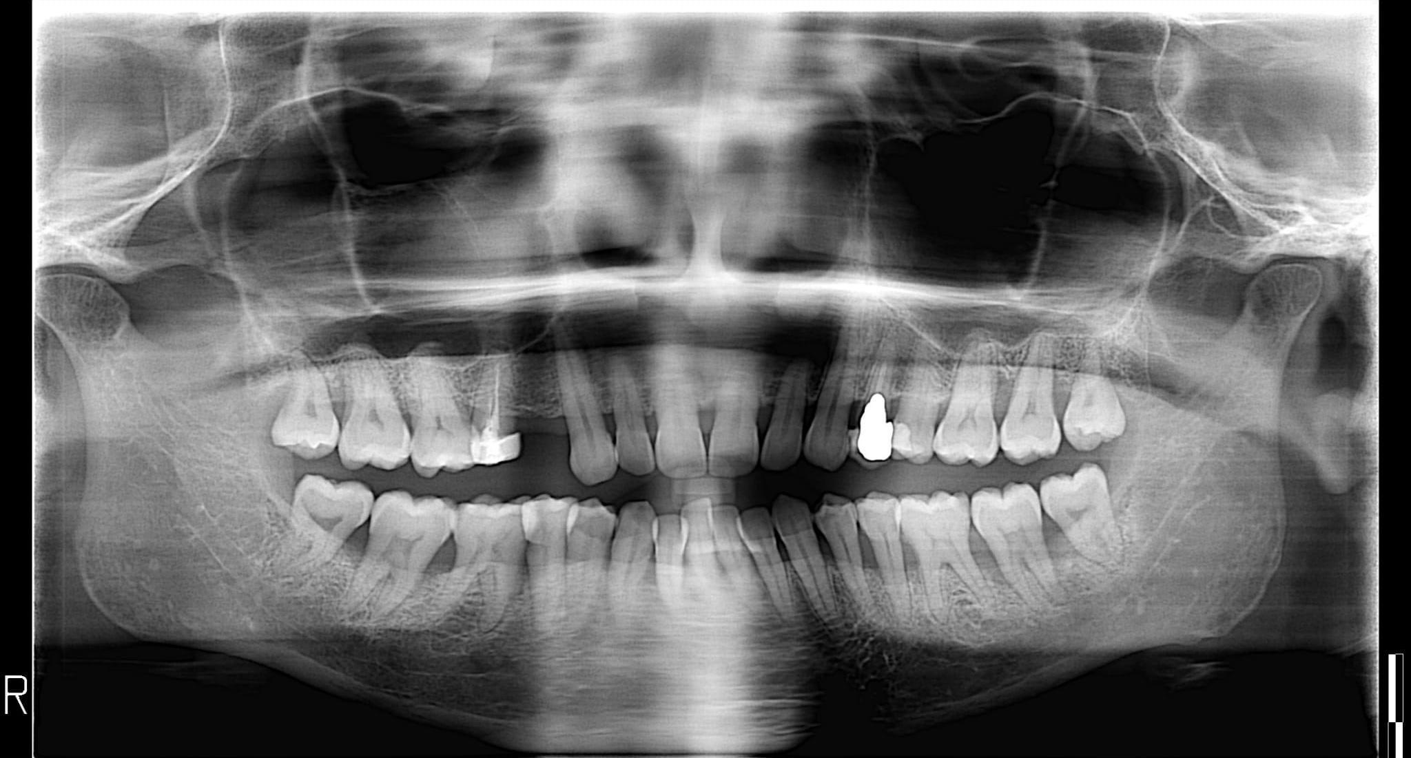 Mi hanno detto che è necessaria l'otturazione di 6 denti e la rimozione dei 4 denti del giudizio