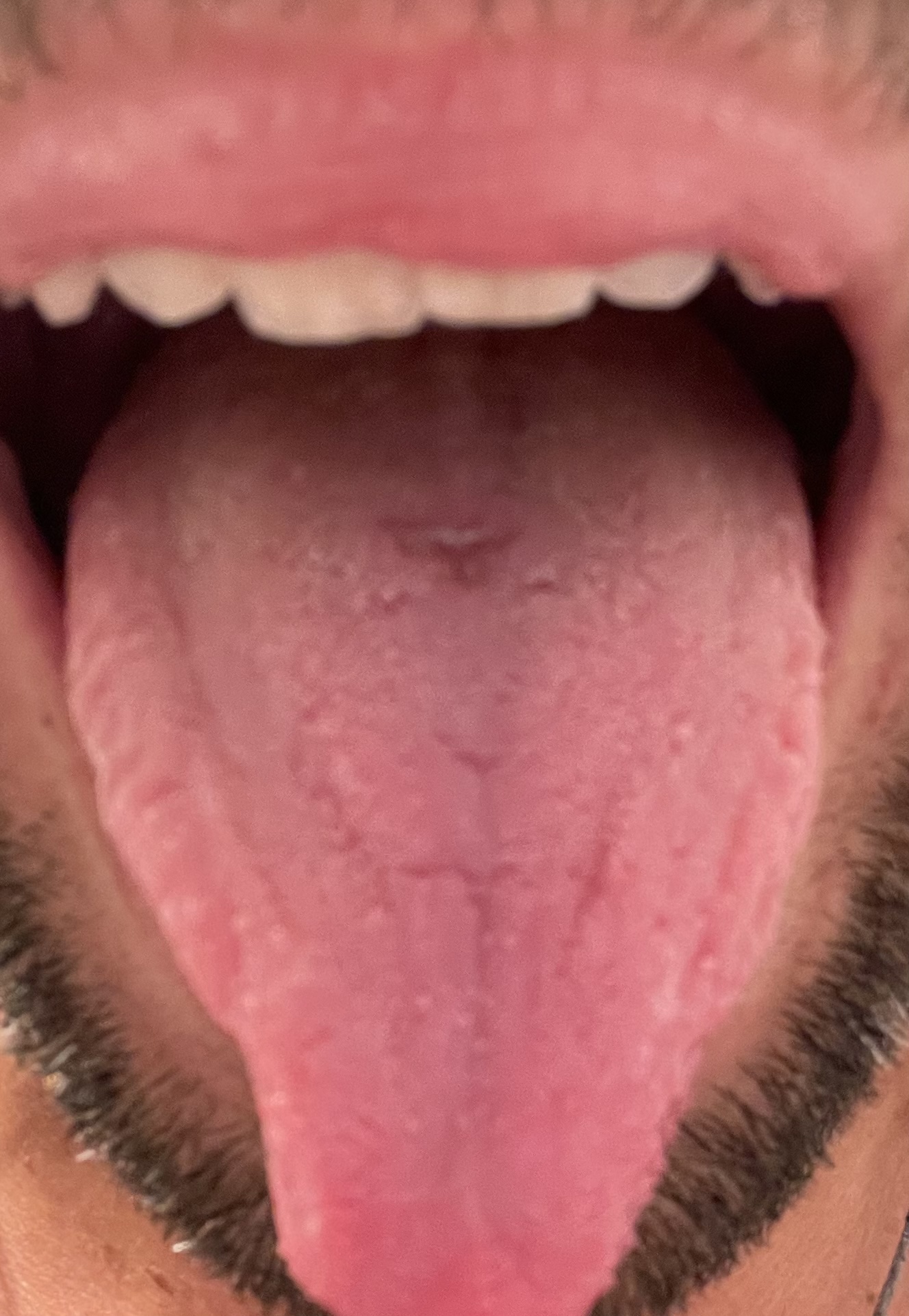 Circa 3 settimane fa ho notato una macchia al centro della lingua