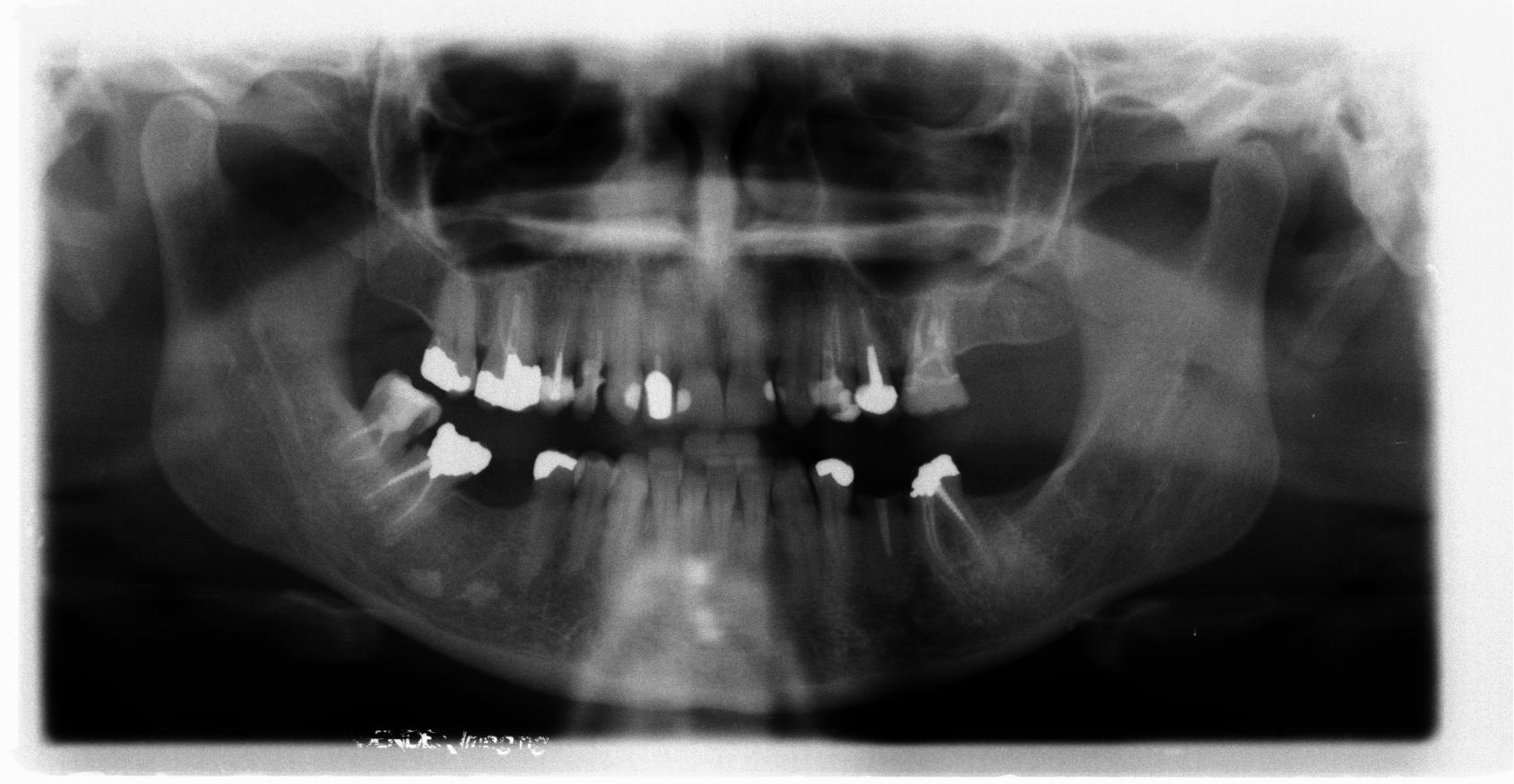 E' possibile comprendere da questa radiografia se c'è una frattura della radice del canino incapsulato?