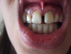 Ho un diastema di  5mm, quali possibili soluzioni mi consigliate?