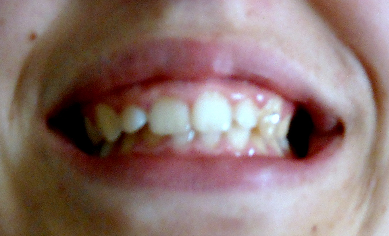 Ho un problema di gummy smile.