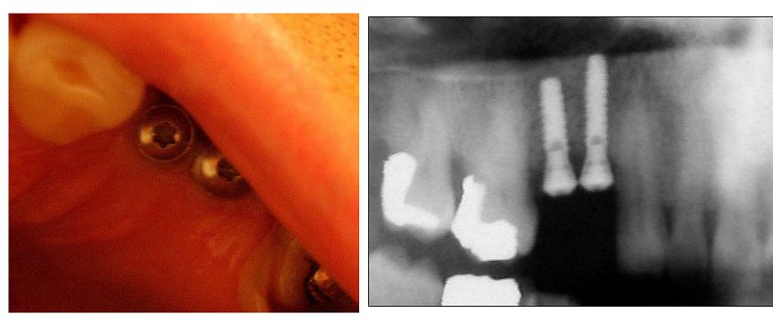 La mancanza di spazio tra due impianti Ã¨ un problema per i denti adiacenti?