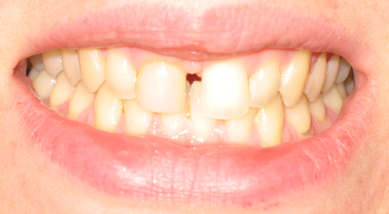 Ho un diastema di circa 2 mm che vorrei eliminare